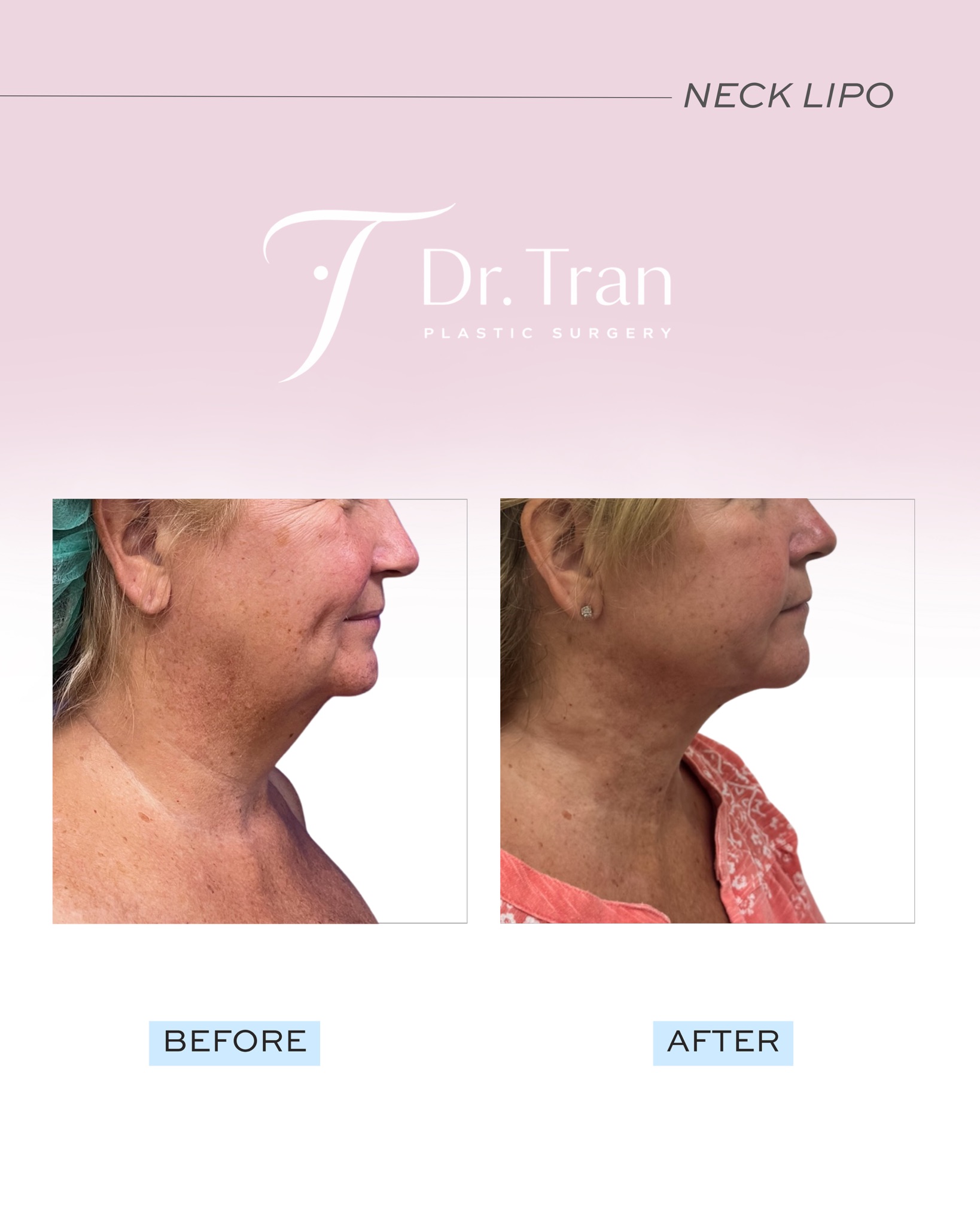 Before and After Image: Neck and lower face liposuction - right-side