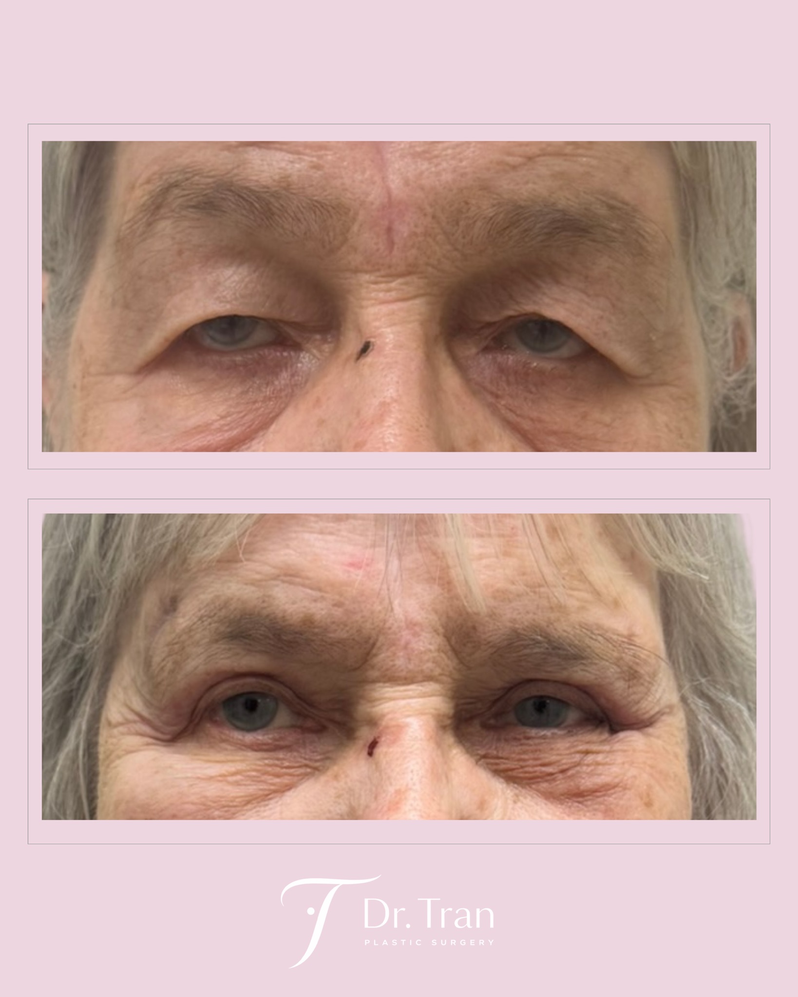 Before and After Image: Upper eyelid surgery (blepharoplasty)
