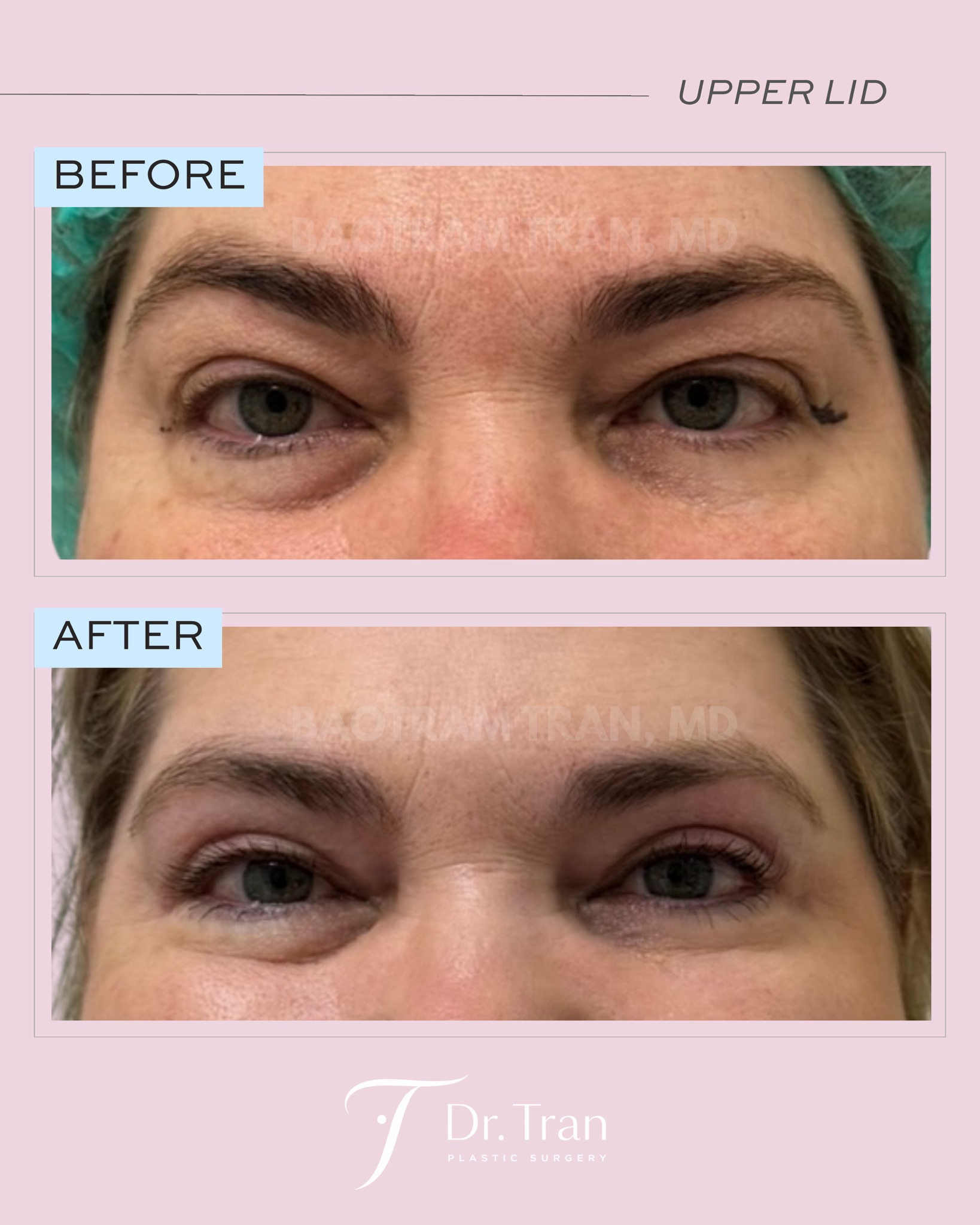 Before and After Image: Upper eyelid surgery