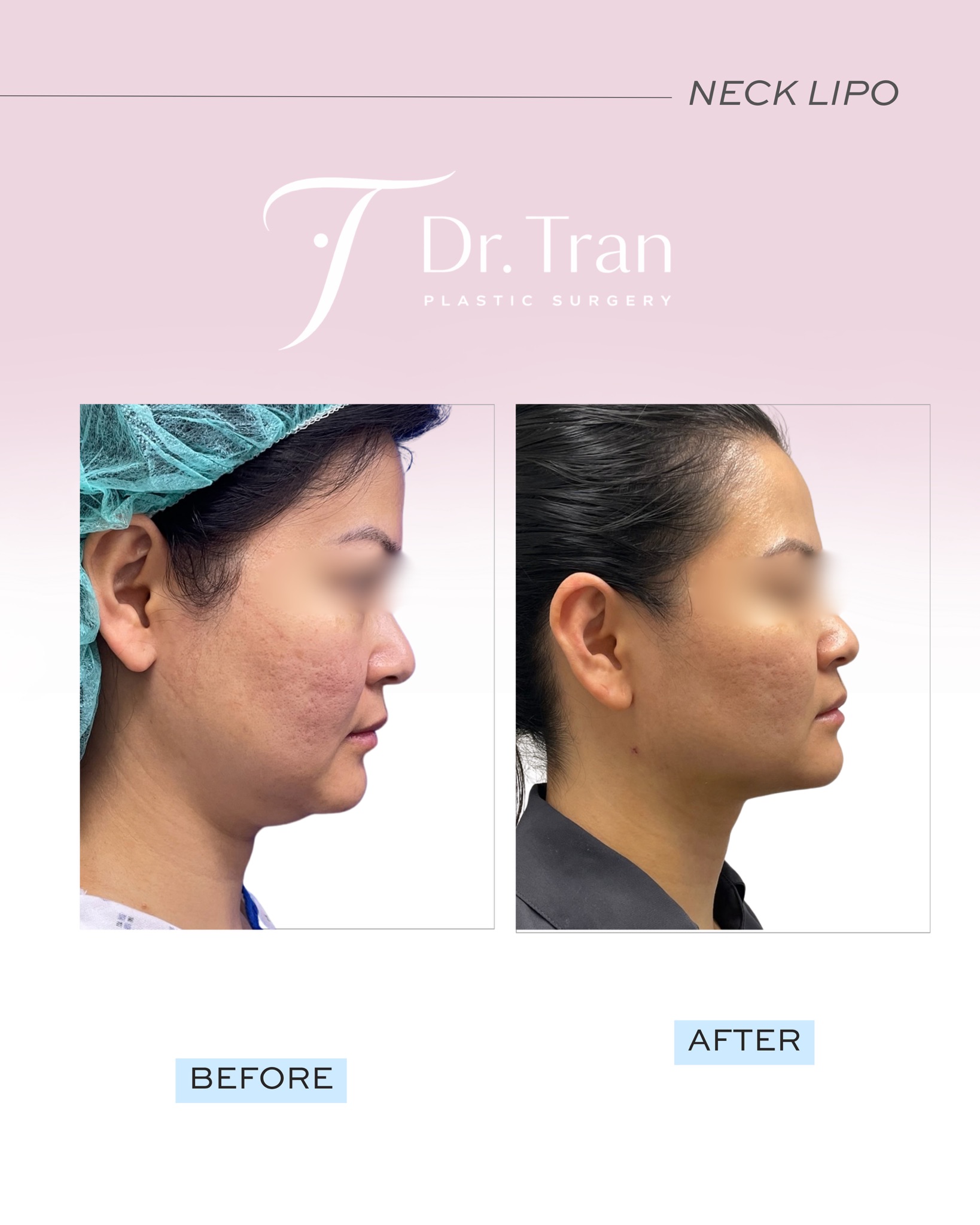 Before and After Image: Neck liposuction - right-side