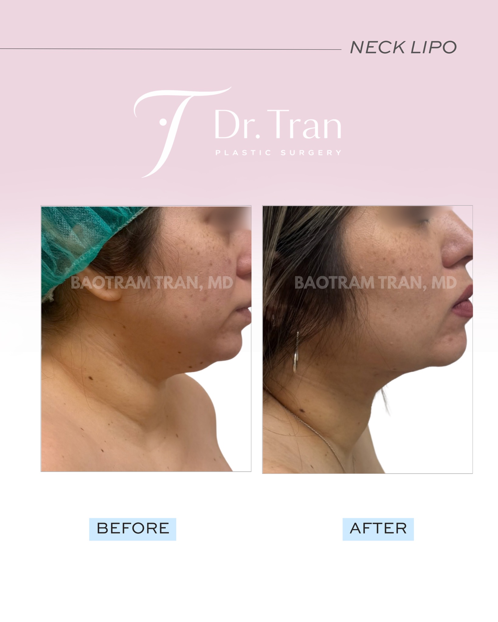 Before and After Image: Neck liposuction - right-side