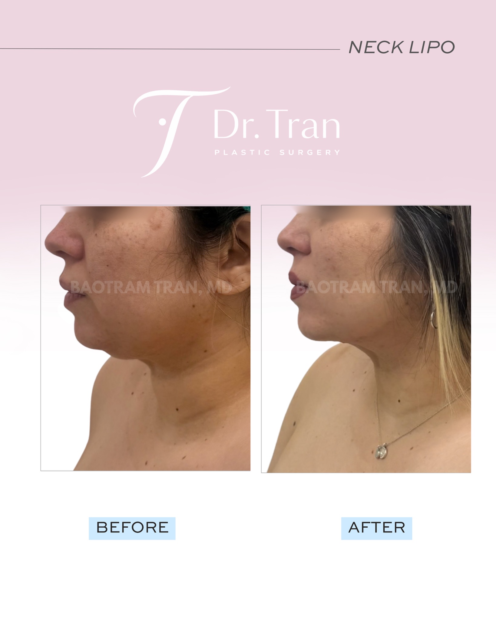 Before and After Image: Neck liposuction - left-side