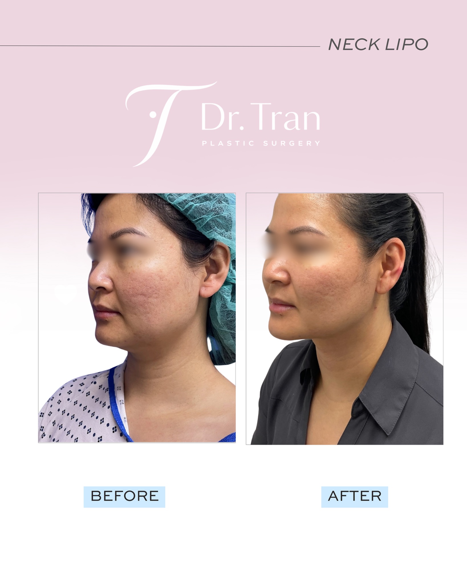 Before and After Image: Neck liposuction - left-front-oblique