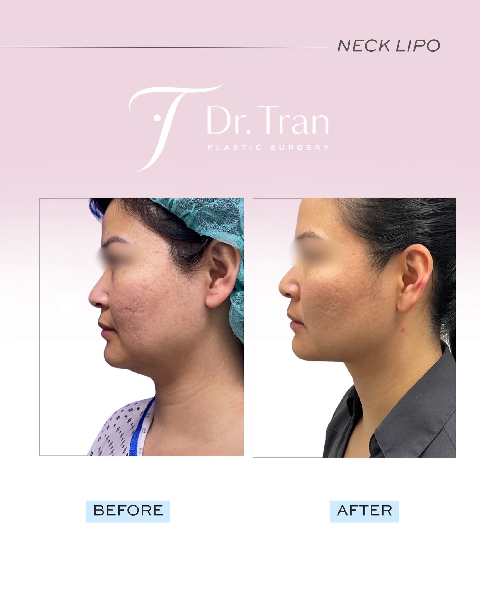 Before and After Image: Neck liposuction - left-side