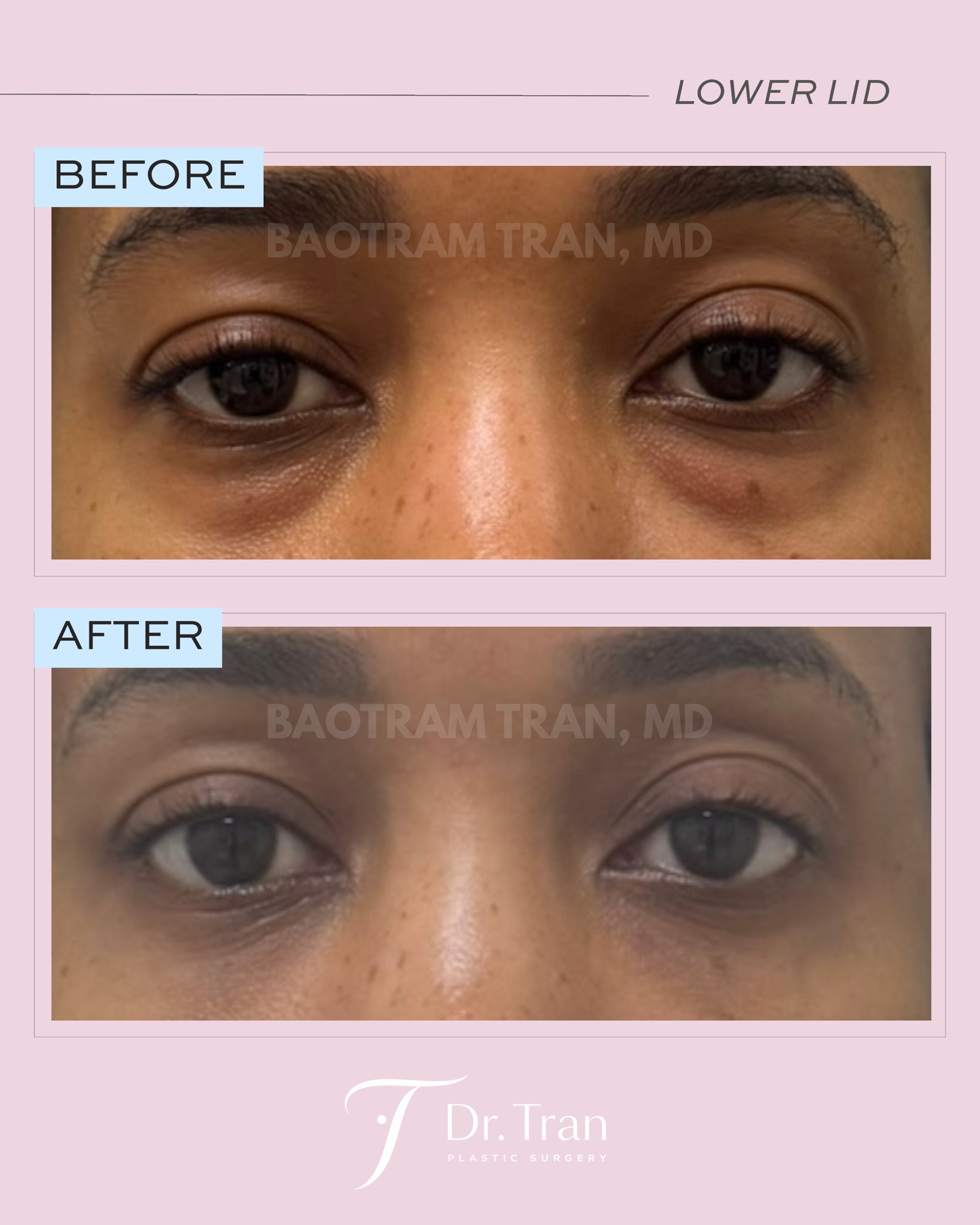 Before and After Image: Lower eyelid surgery, scarless