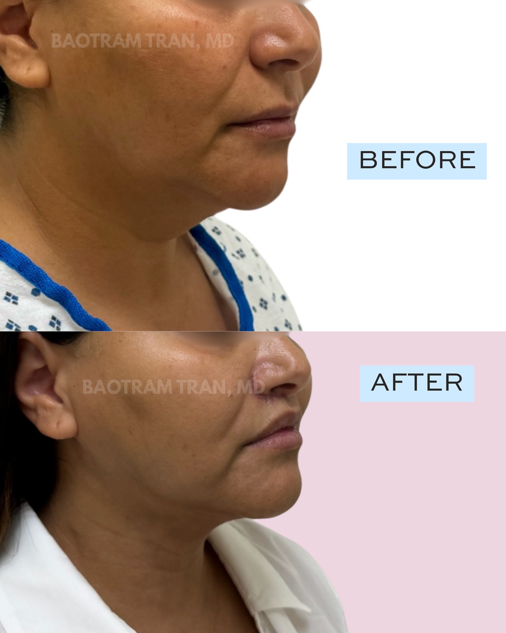 Before and After Image: Lip lift and neck liposuction - right-front-oblique
