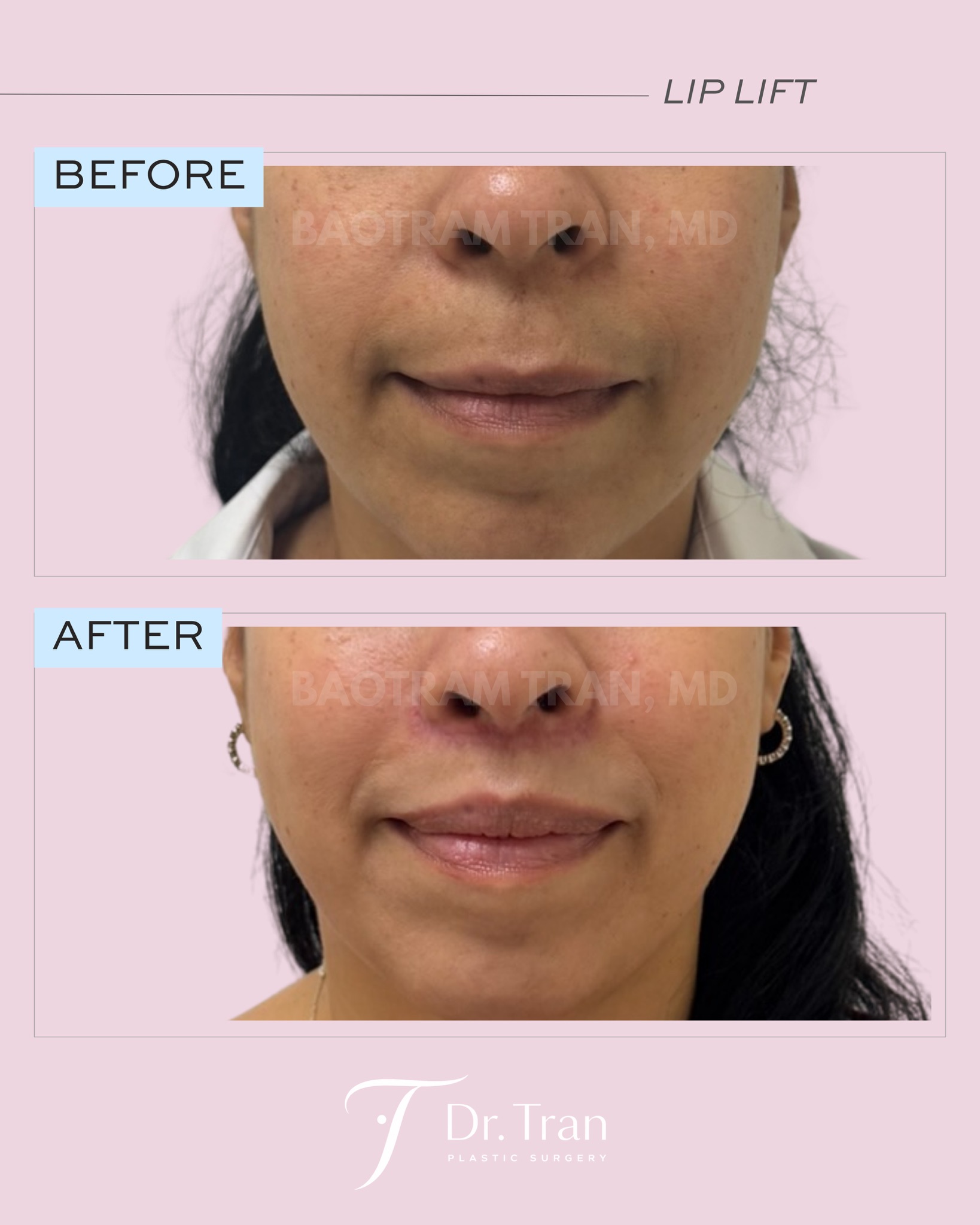 Before and After Image: Lip Lift - front