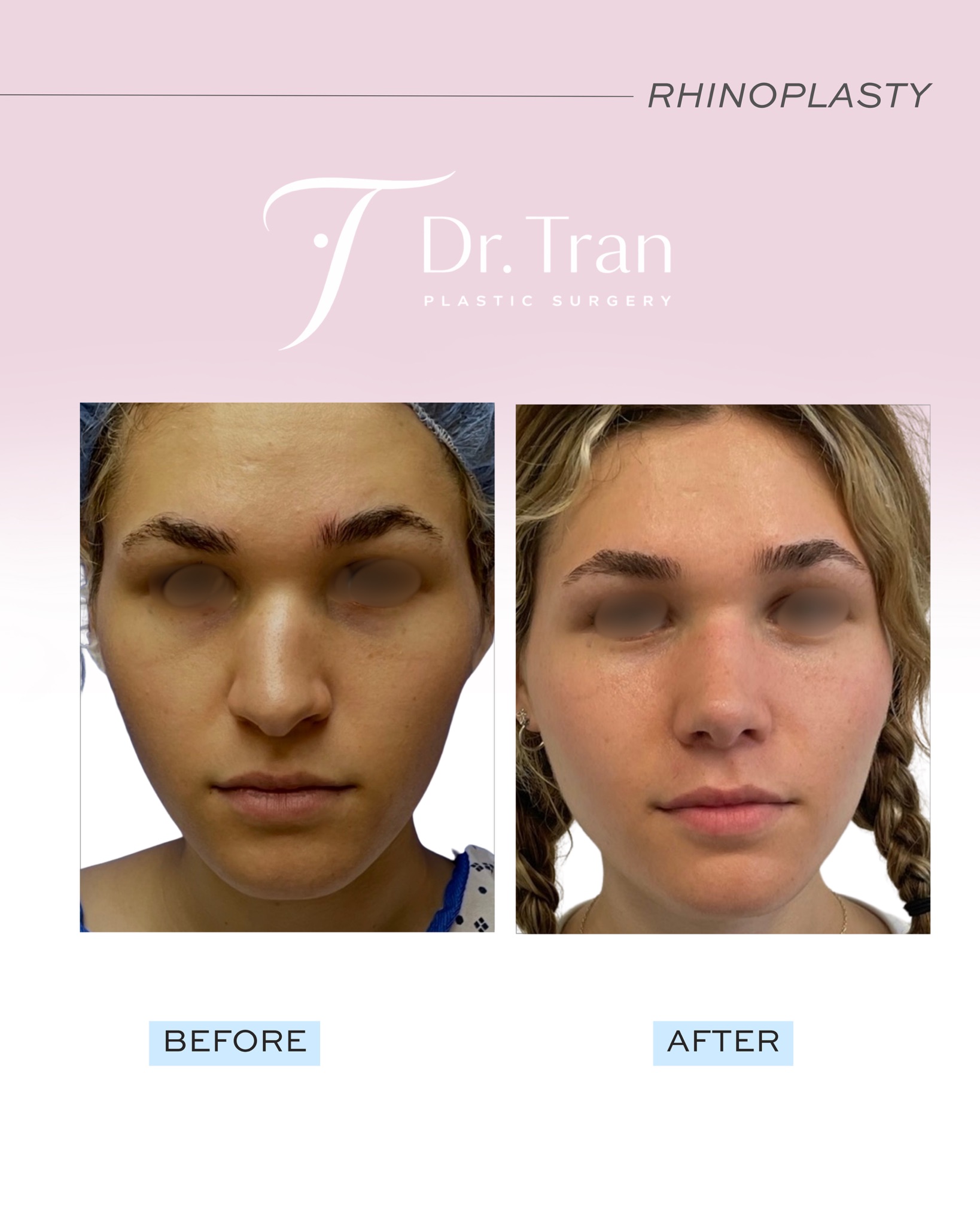 Before and After Image: Rhinoplasty - front