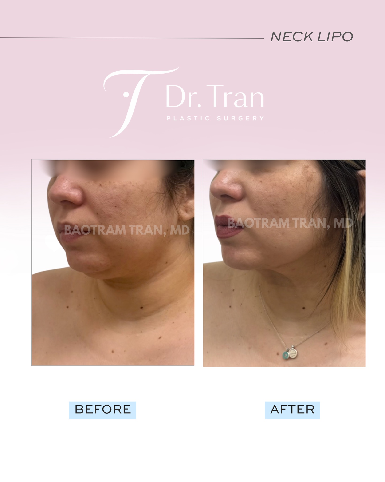 Before and After Image: Neck liposuction - left-front-oblique
