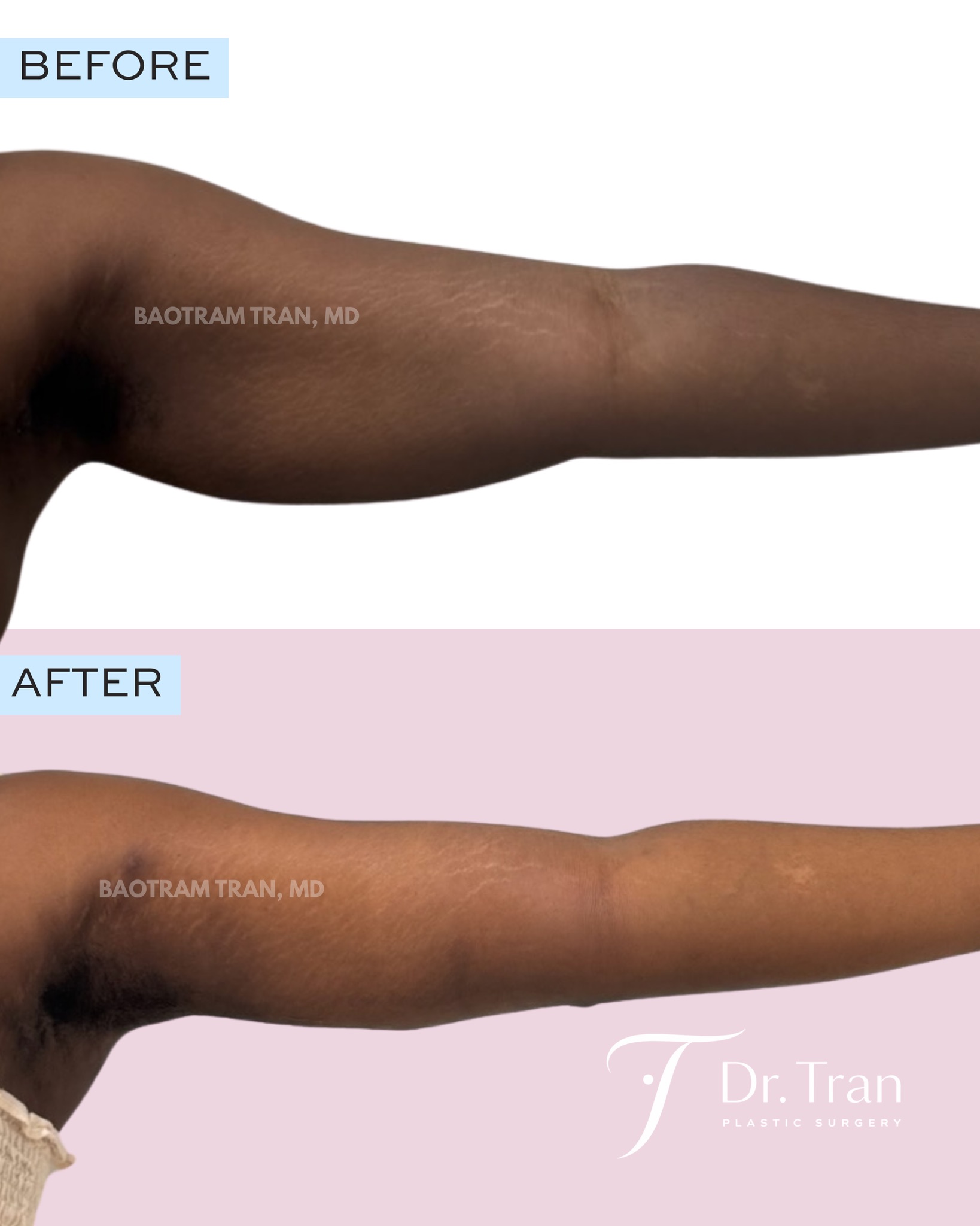 Before and After Image: Arm Lift and liposuction - front