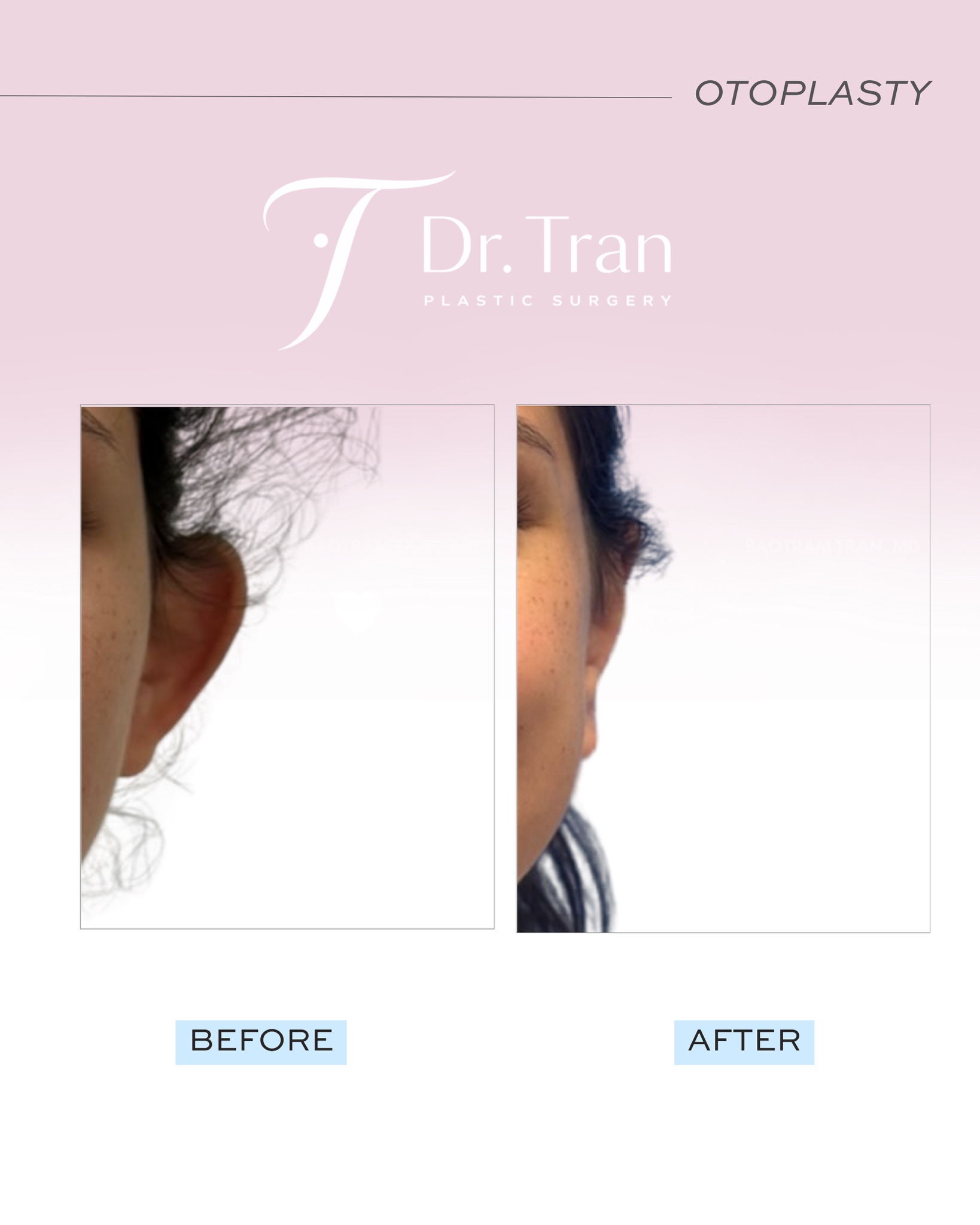 Before and After Image: Otoplasty (Ear pinning) - front
