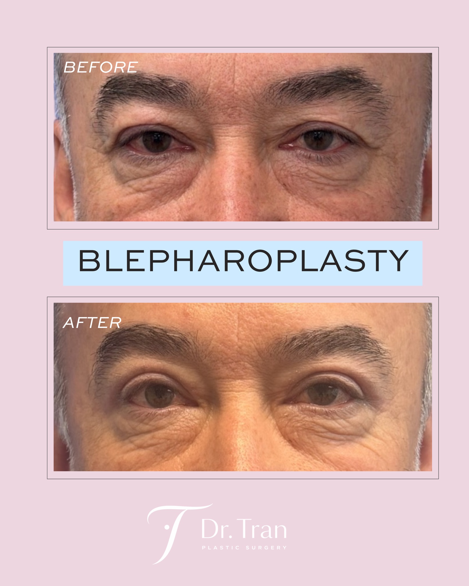 Before and After Image: Upper eyelid surgery - front