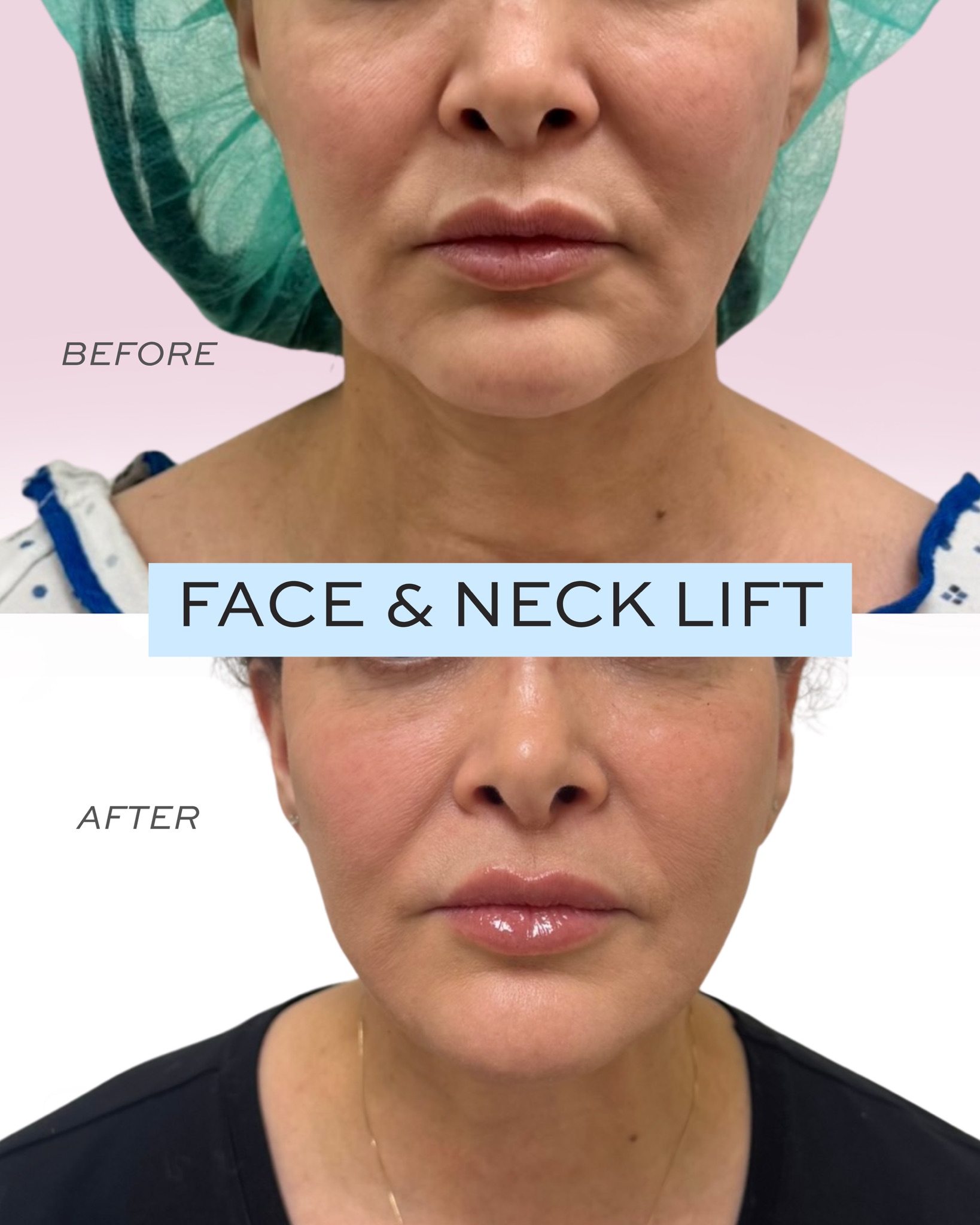 Before and After Image: Facelift and Neck lift - front