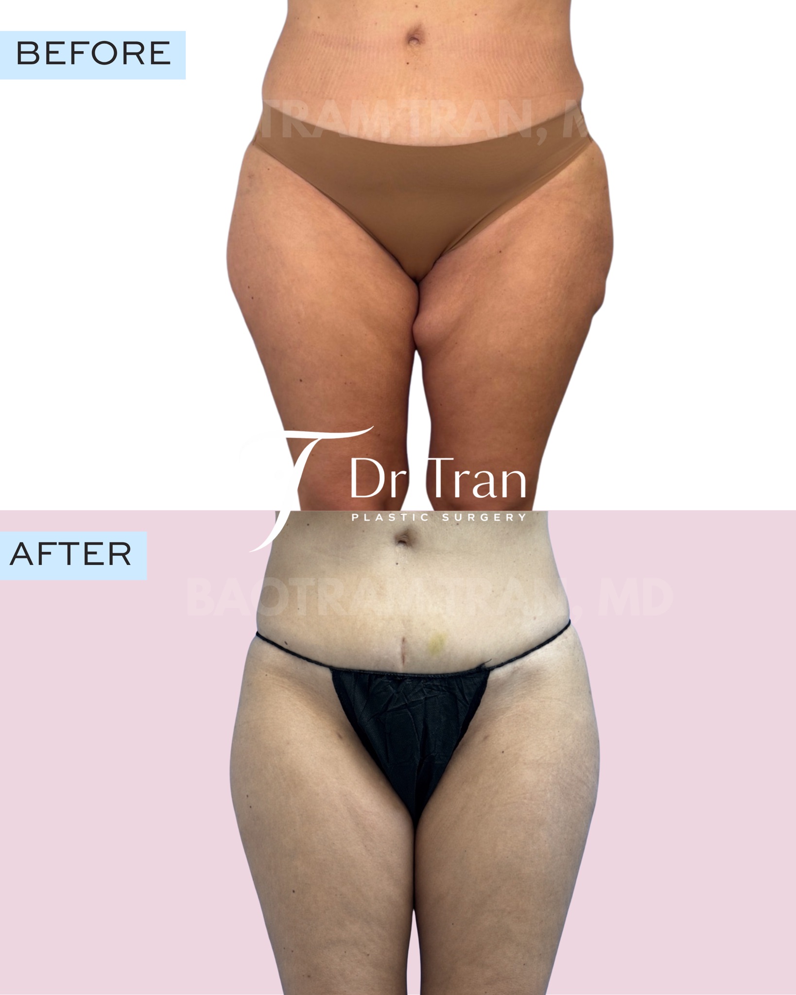 Before and After Image: Skin tightening with Quantum RF - front