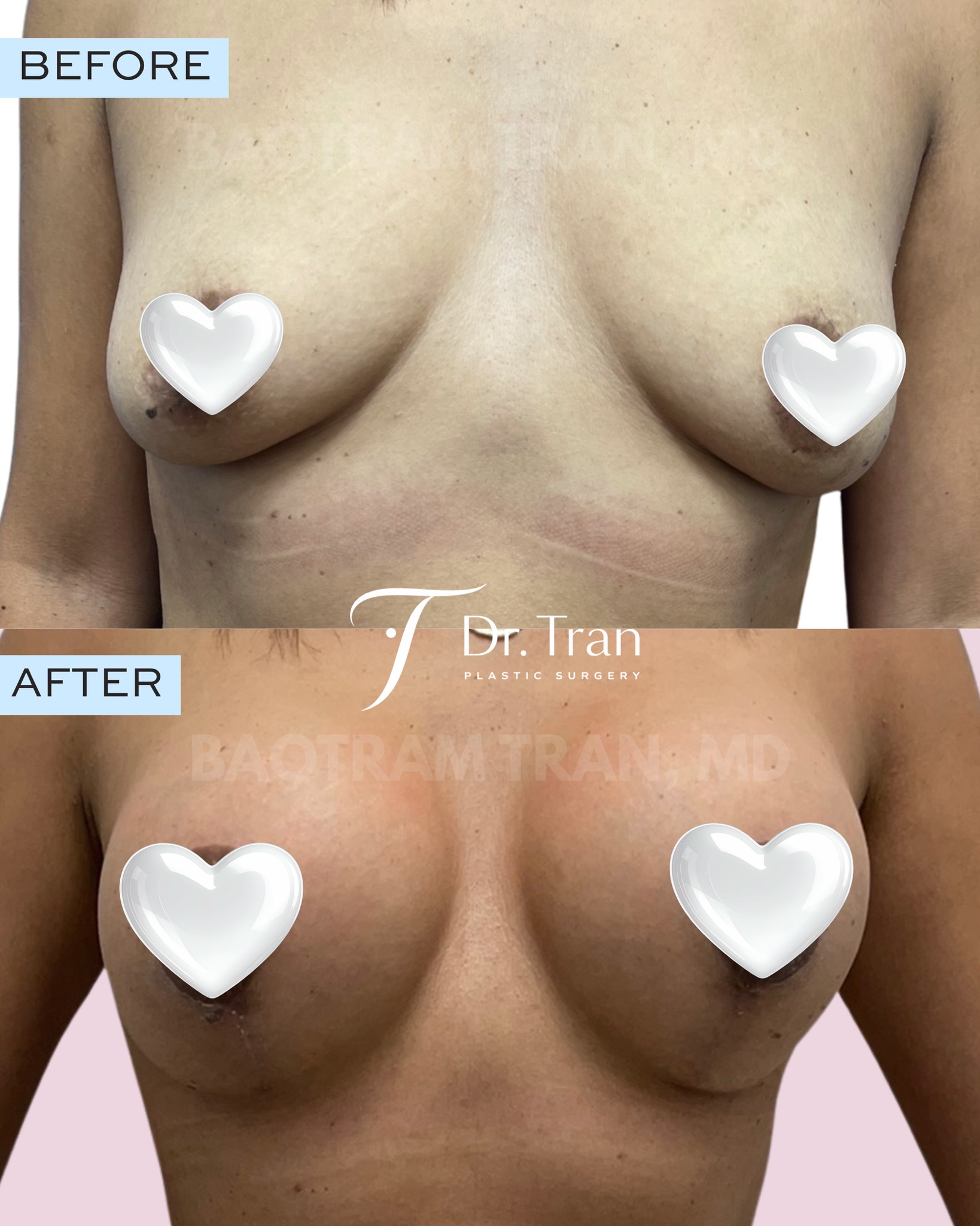 Before and After Image: Breast lift with implants - front