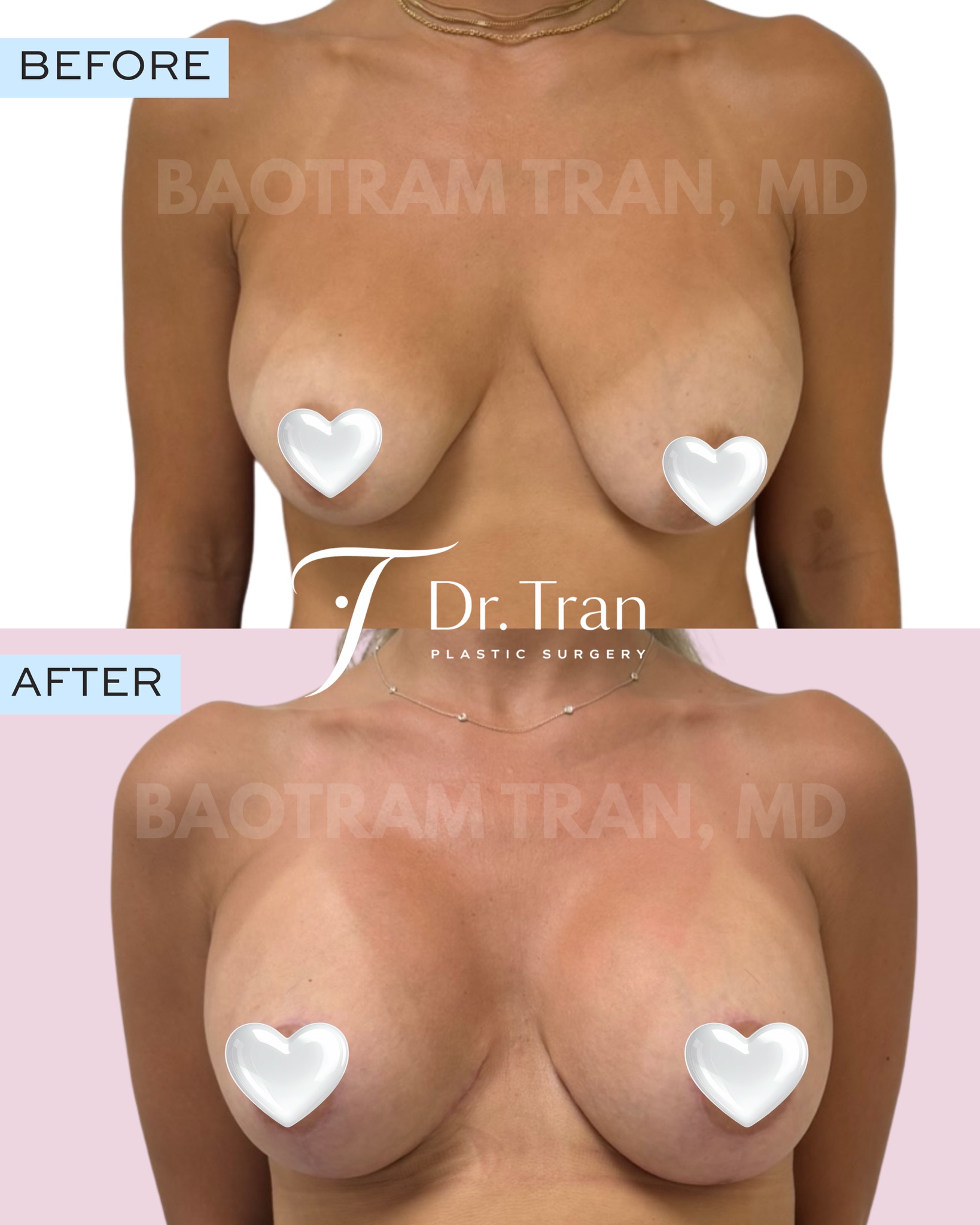 Before and After Image: Breast lift and implant exchange - front