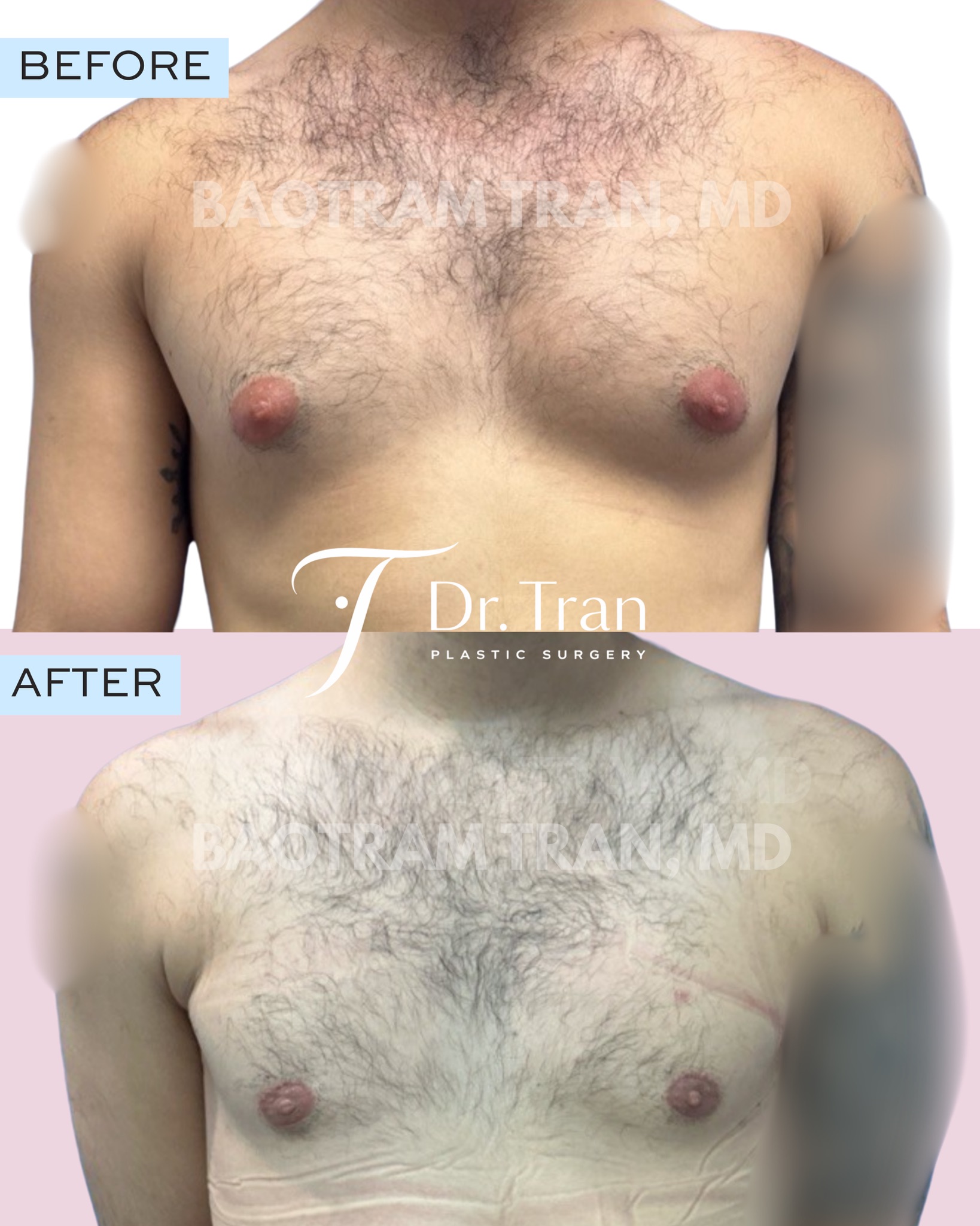 Before and After Image: Gynecomastia surgery - front
