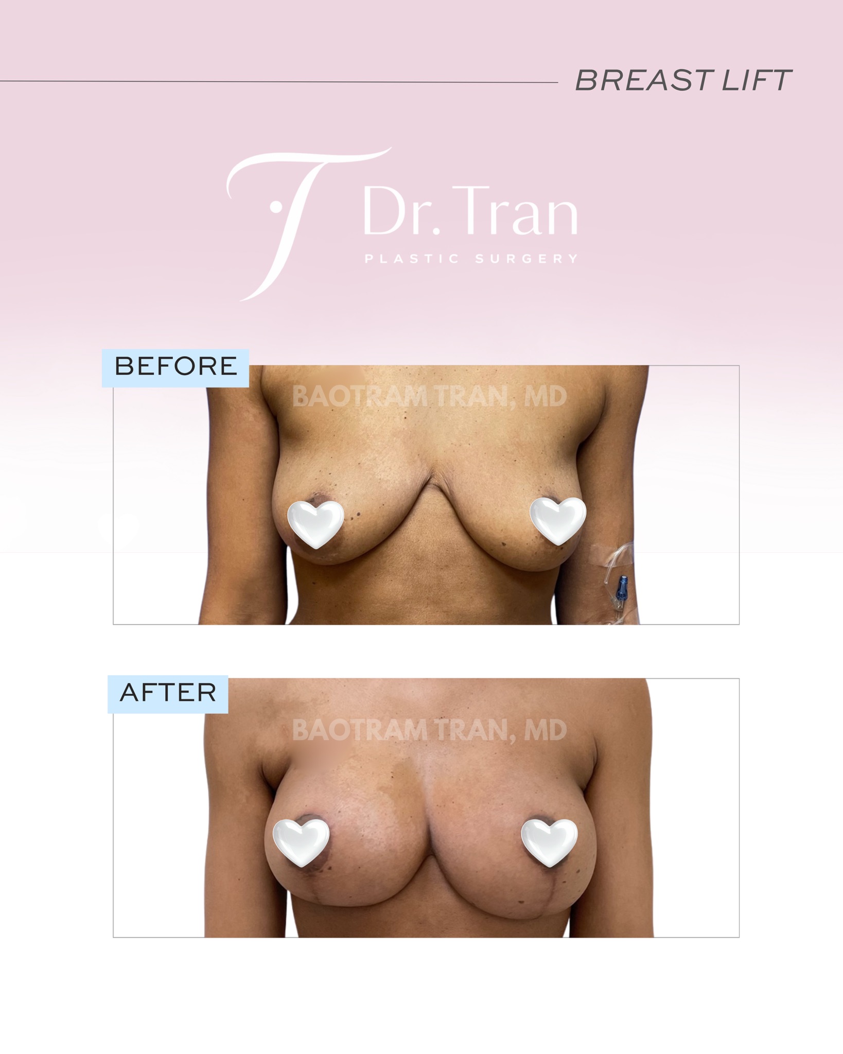 Before and After Image: Breast lift with implants - front