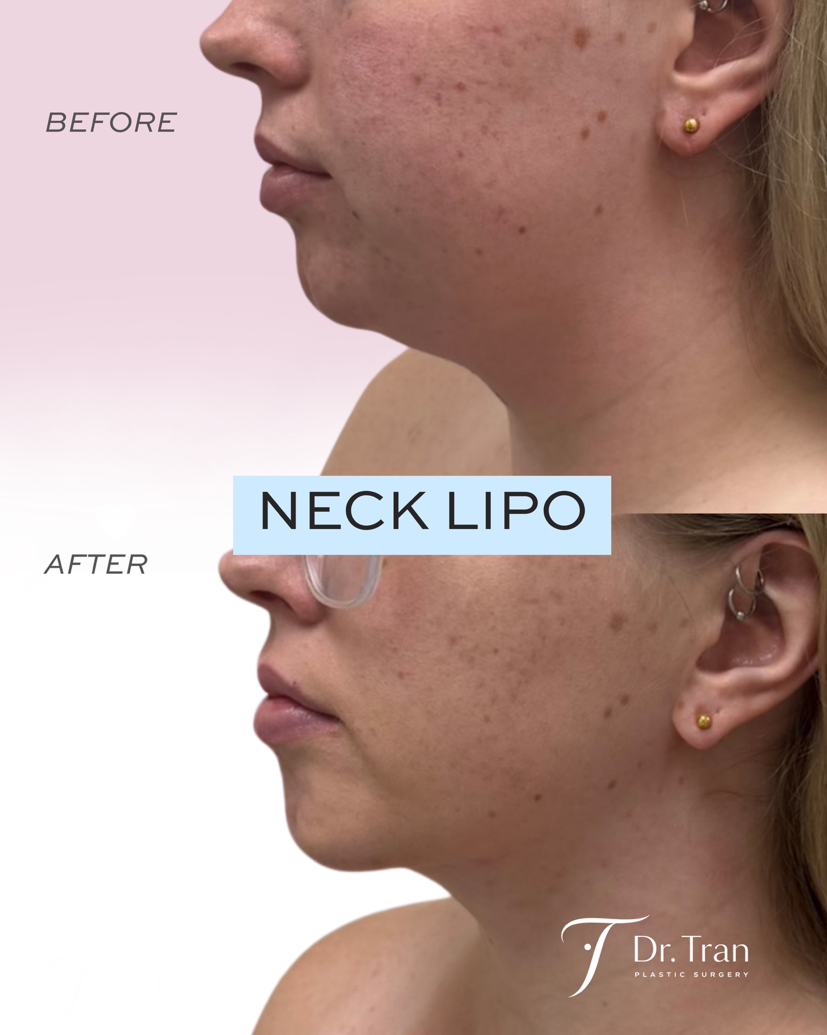Before and After Image: Neck Liposuction - left-side