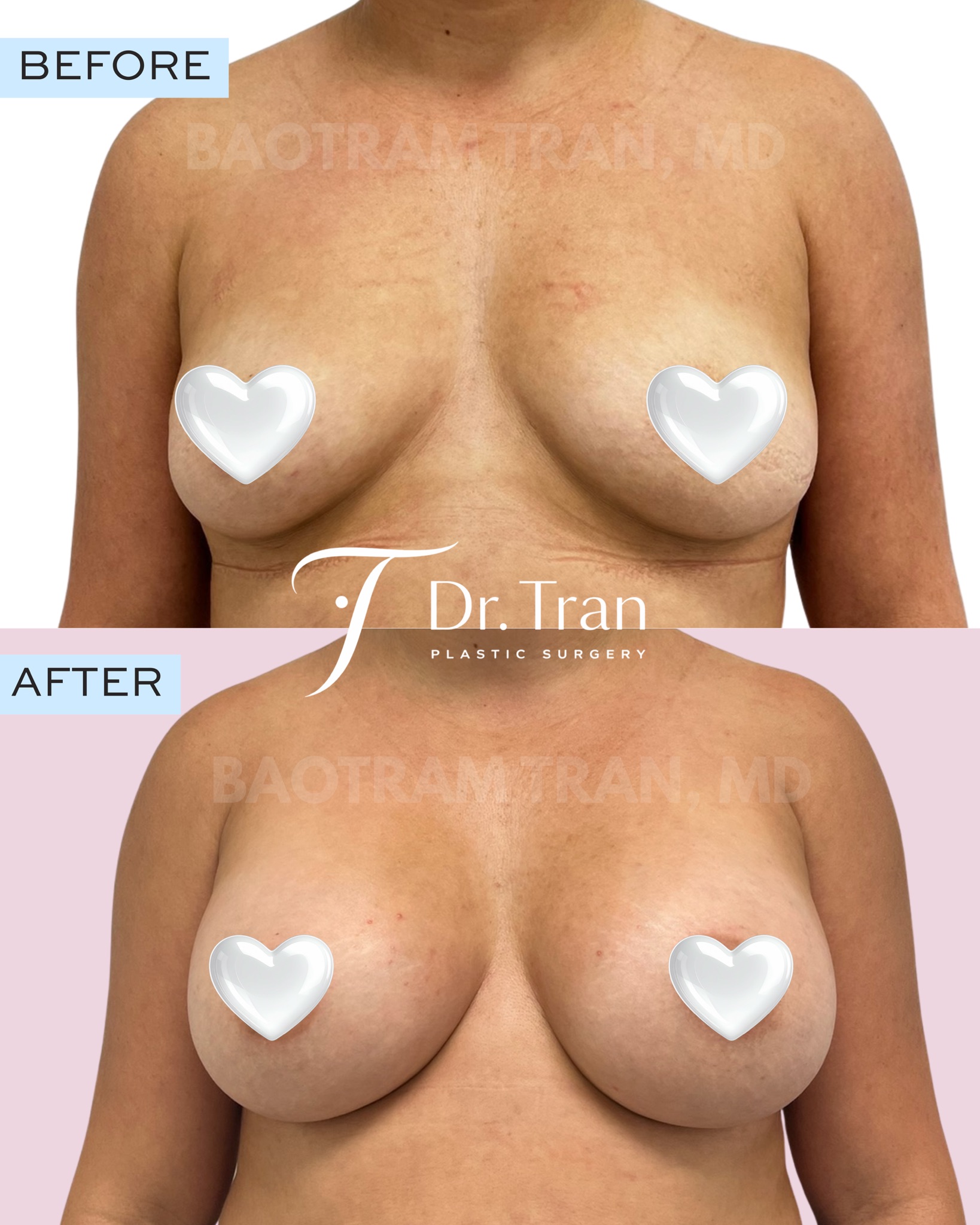 Before and After Image: Breast augmentation