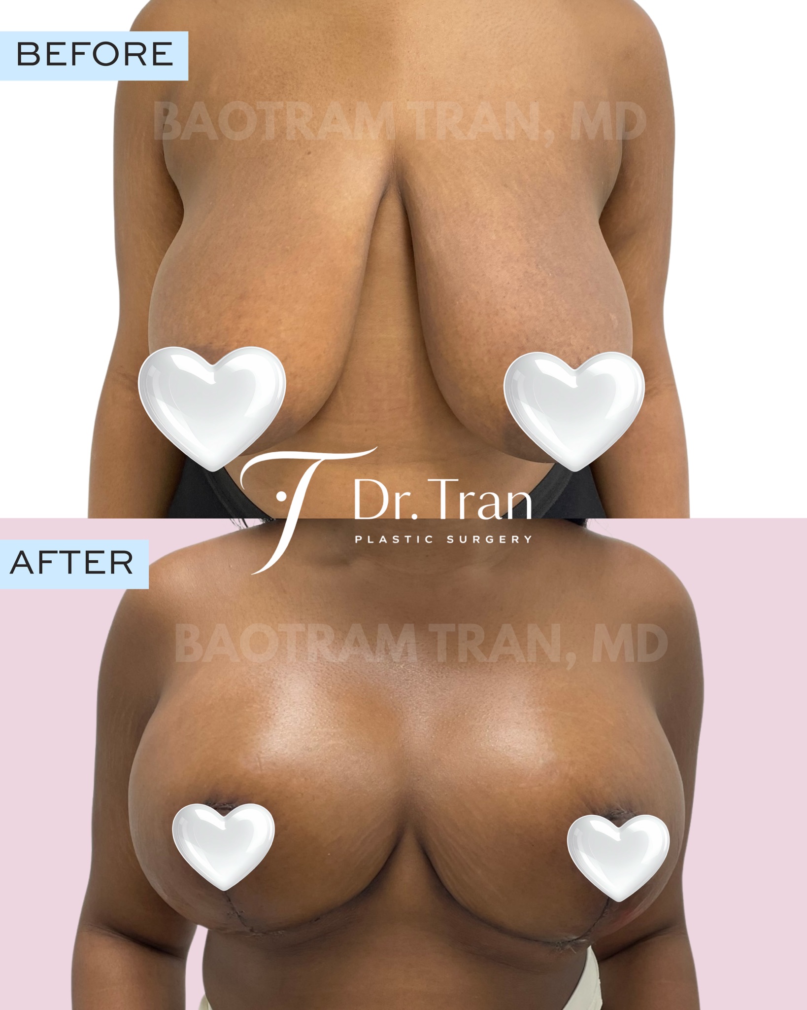 Before and After Image: Breast lift - front