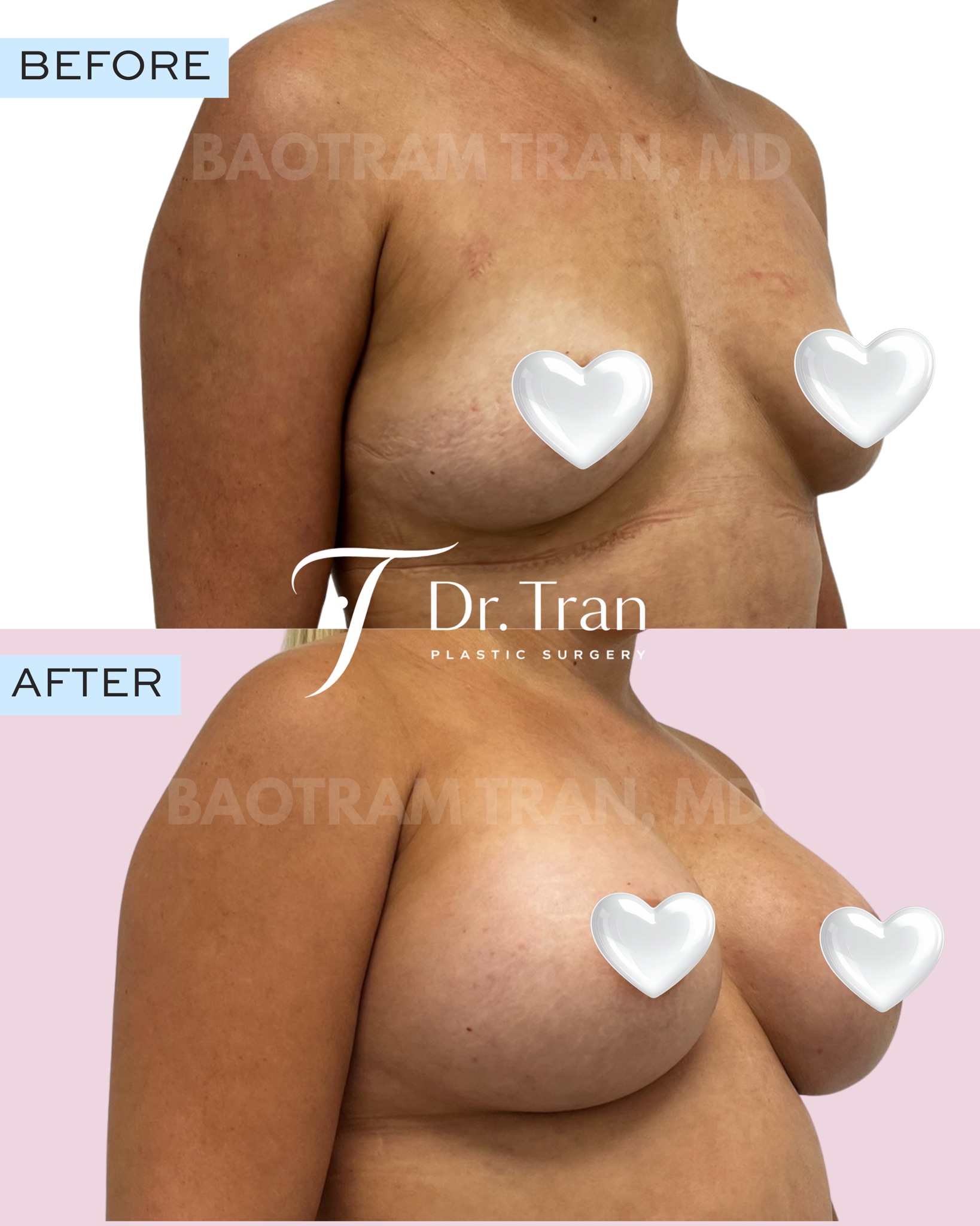 Before and After Image: Breast augmentation - right-front-oblique