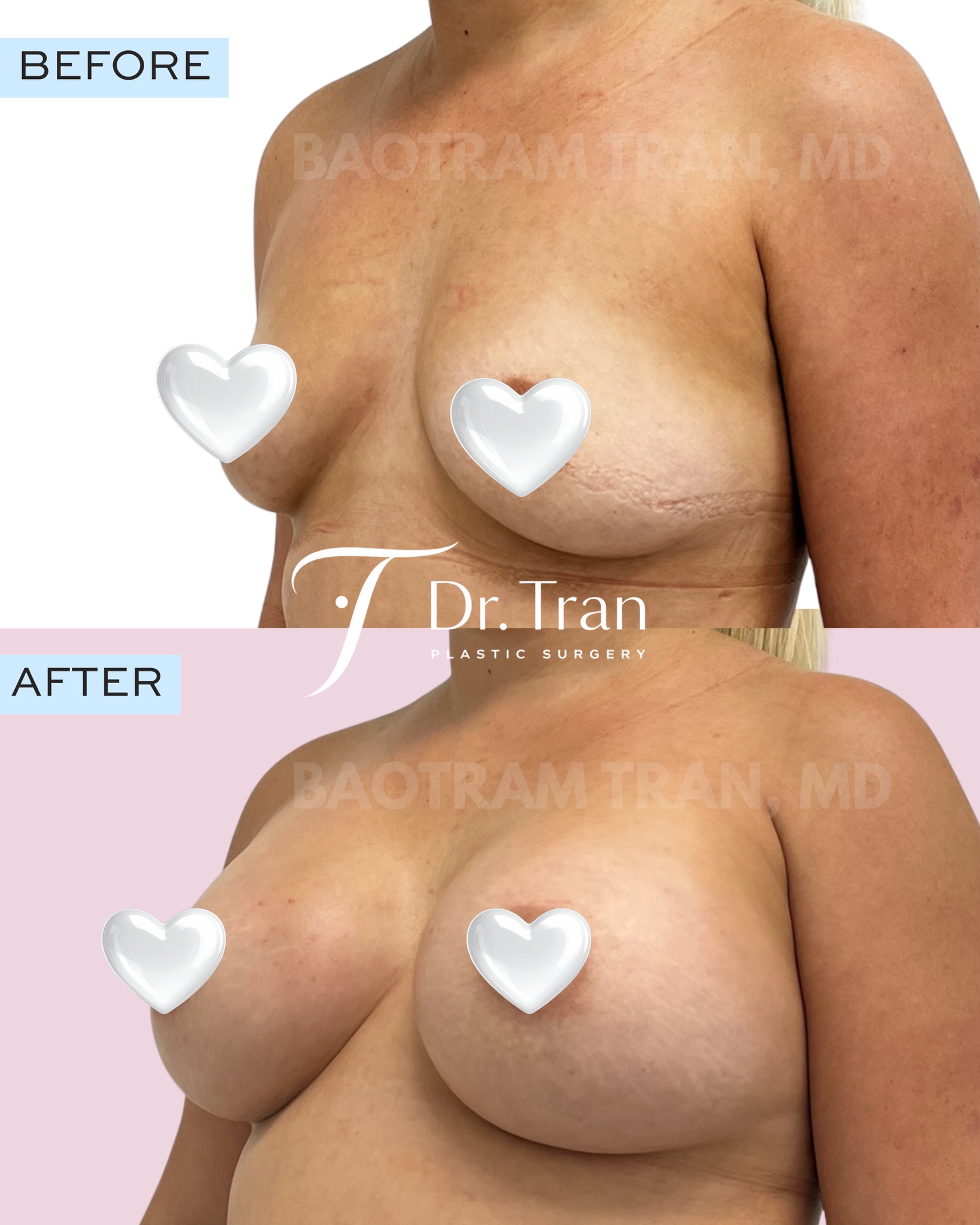 Before and After Image: Breast augmentation - left-front-oblique