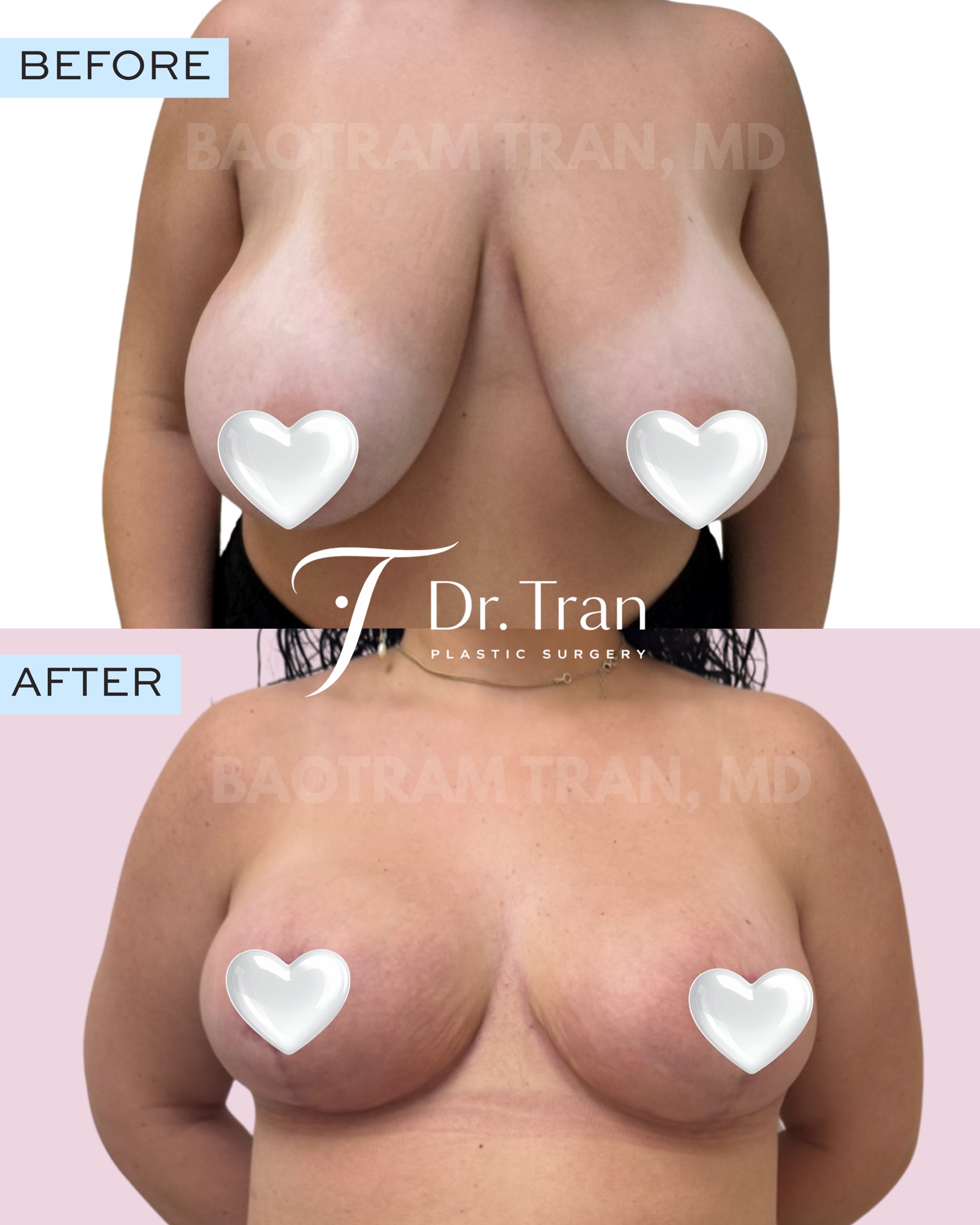 Before and After Image: Breast reduction