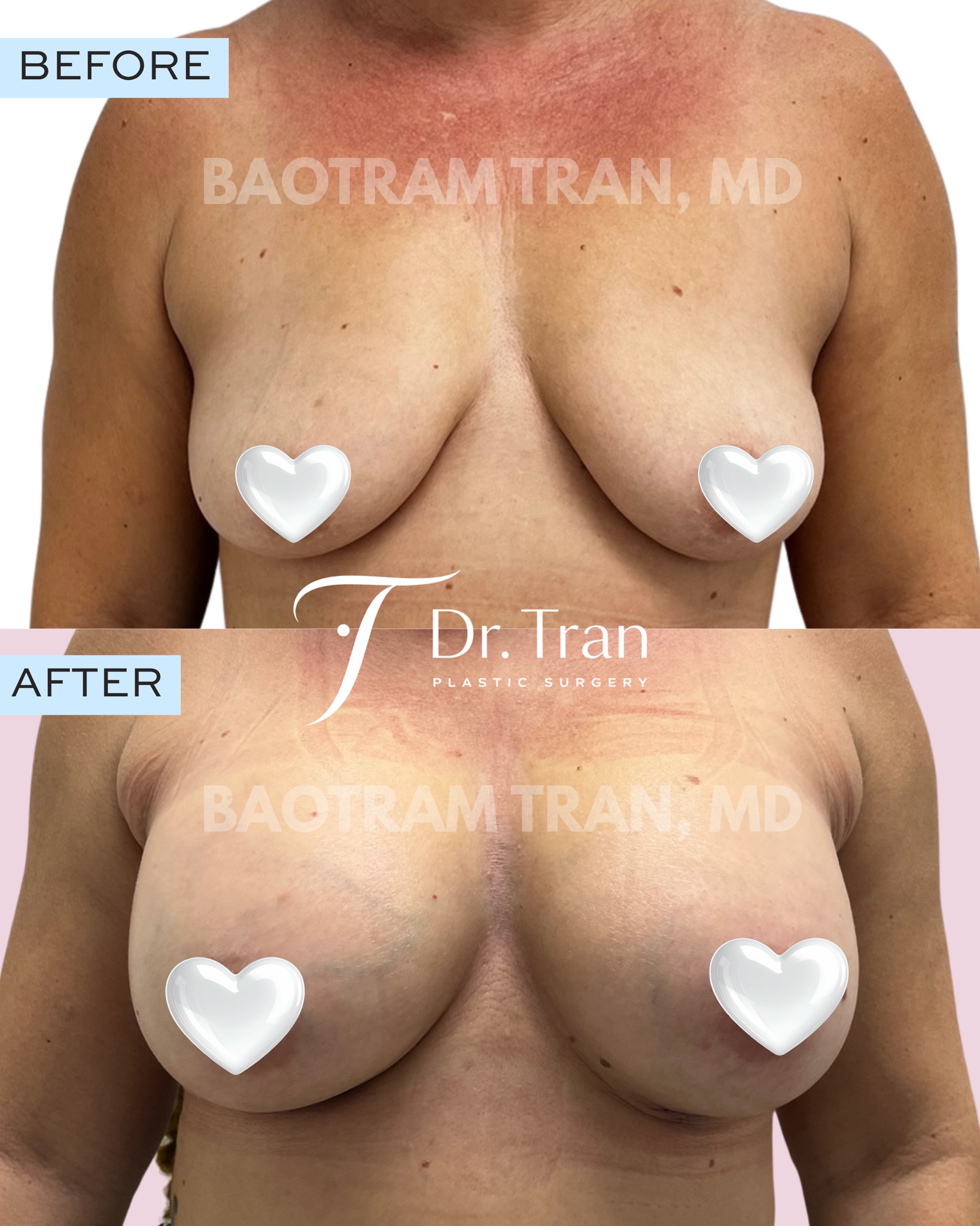 Before and After Image: Breast Augmentation