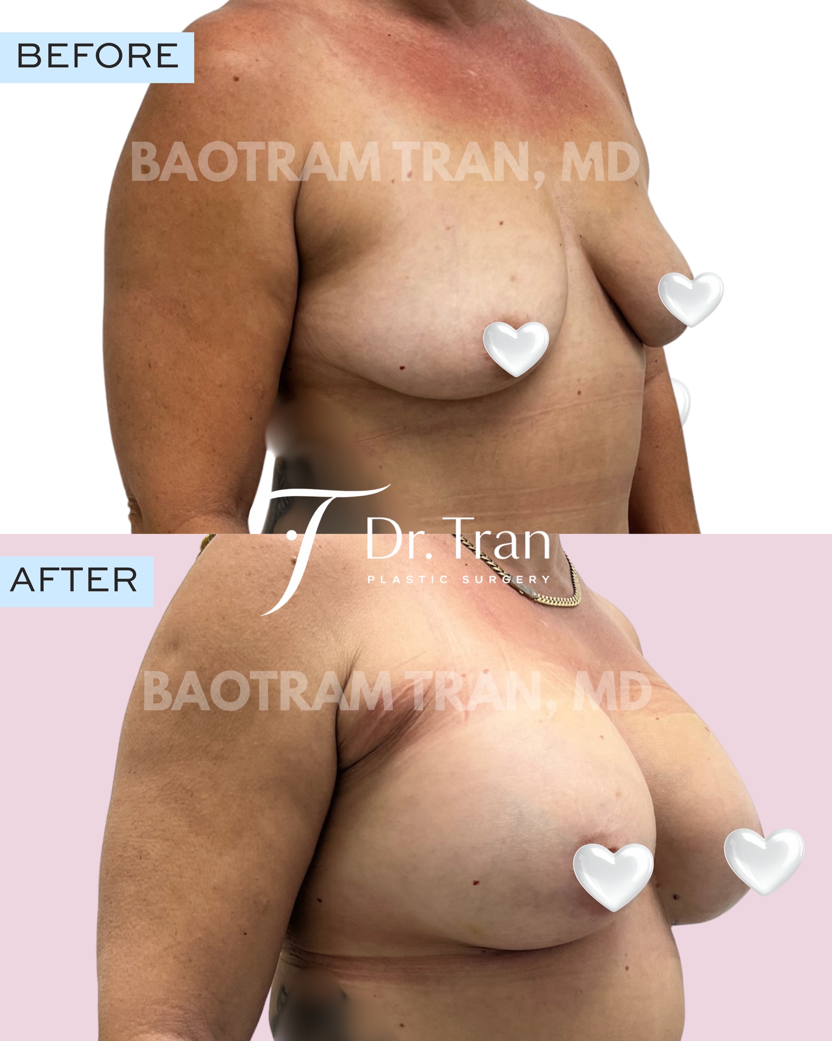 Before and After Image: Breast Augmentation - right-front-oblique