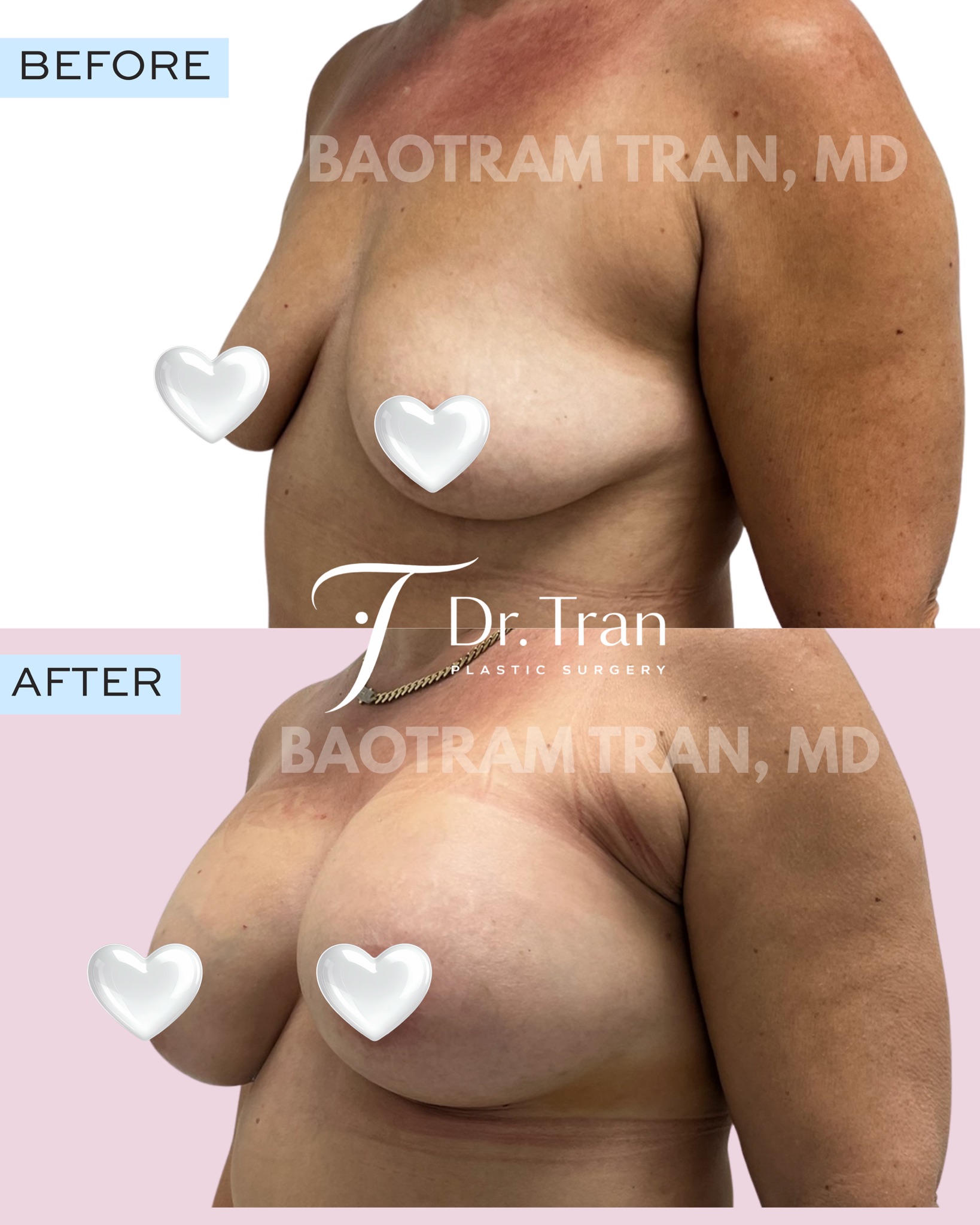 Before and After Image: Breast Augmentation - left-front-oblique