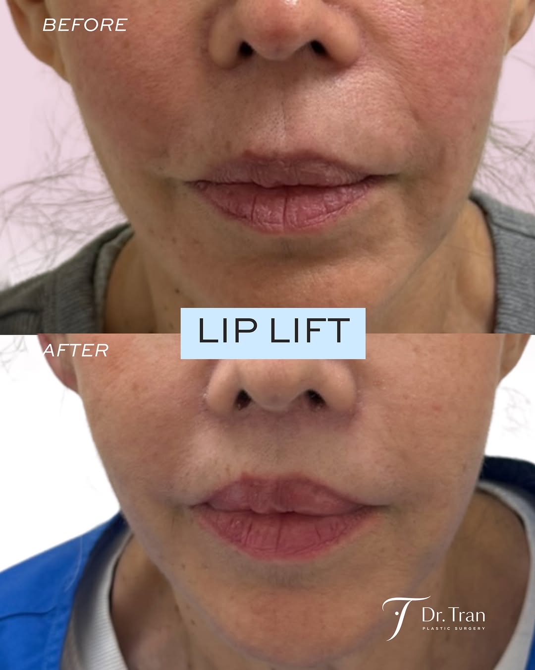 Before and After Image: Lip lift - front
