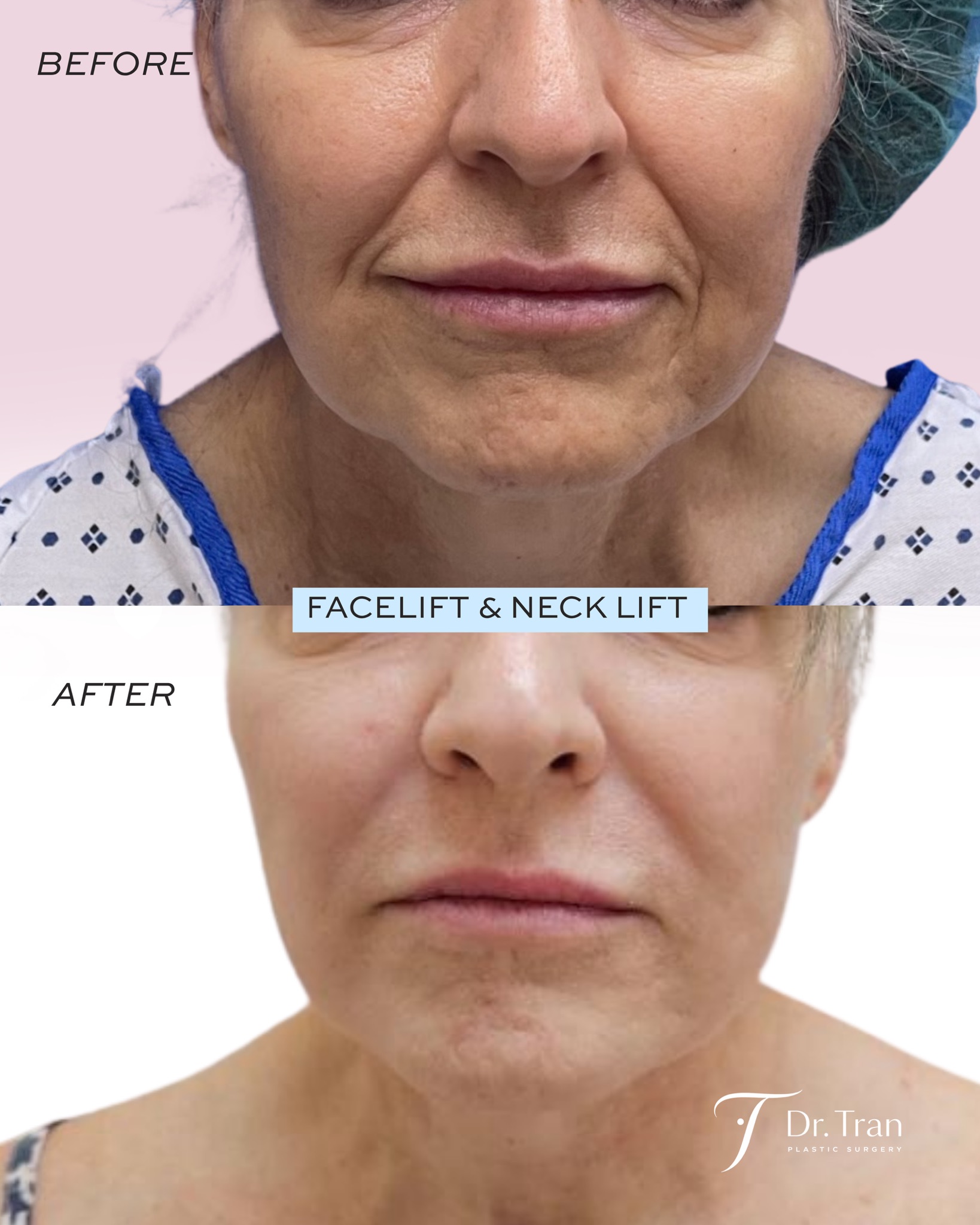 Before and After Image: Facelift and Neck lift - front