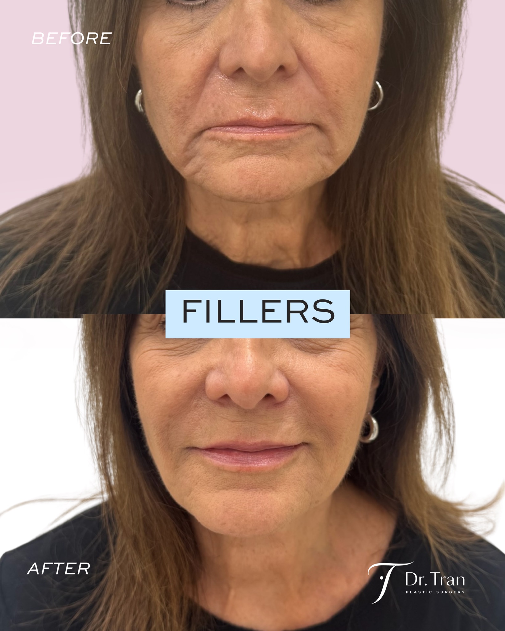 Before and After Image: Dermal fillers to lips, nasolabial folds and Marionette lines - front
