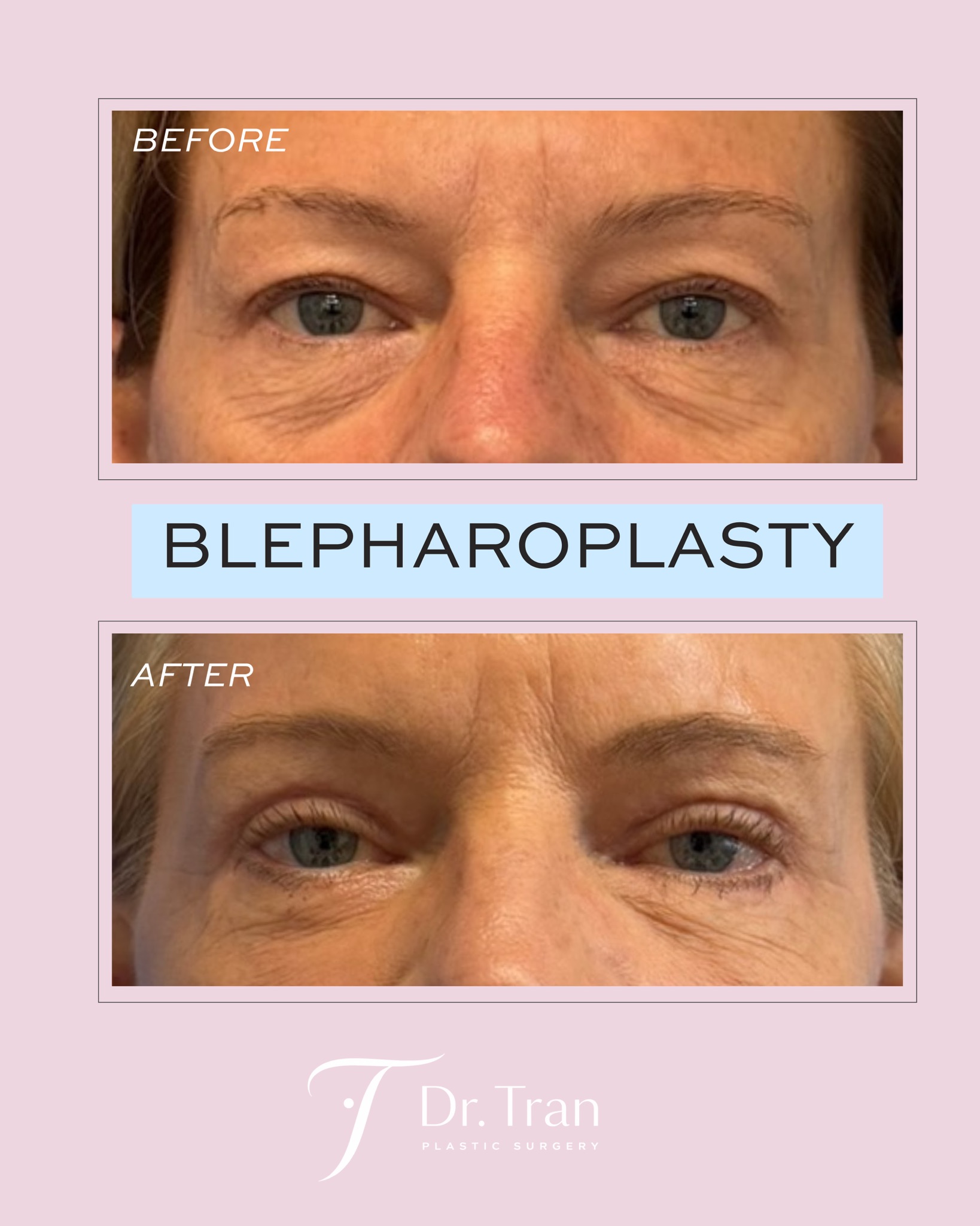 Before and After Image: Upper and lower eyelid surgery