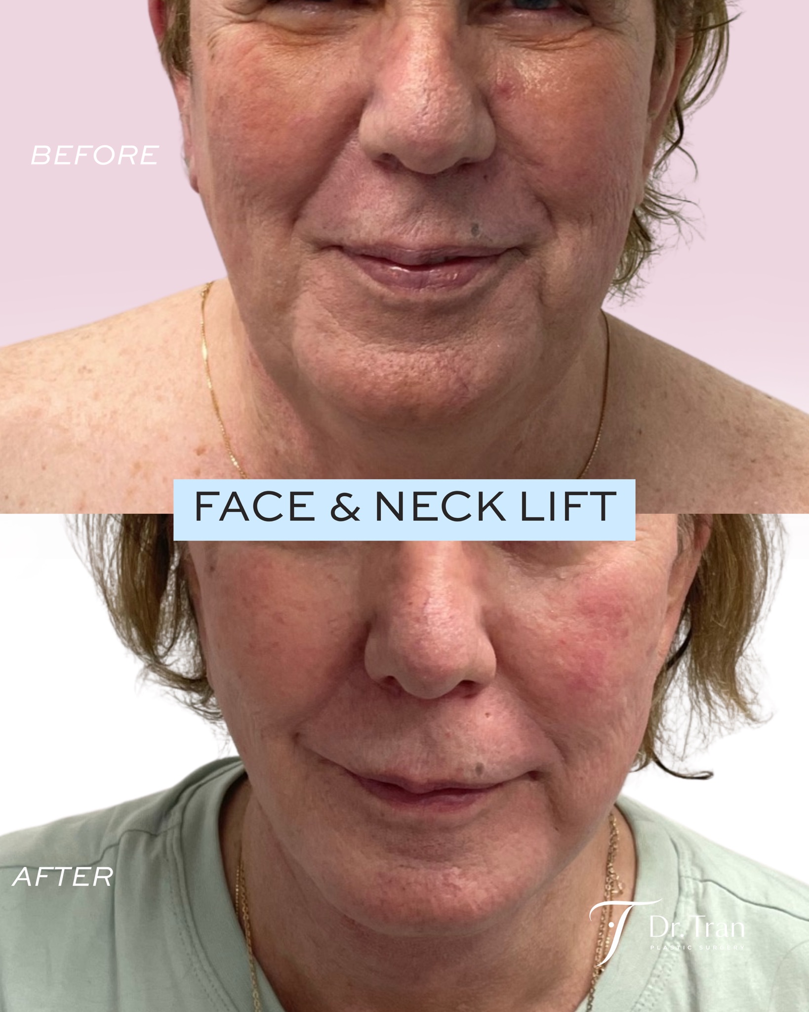 Before and After Image: Facelift and Neck lift - front