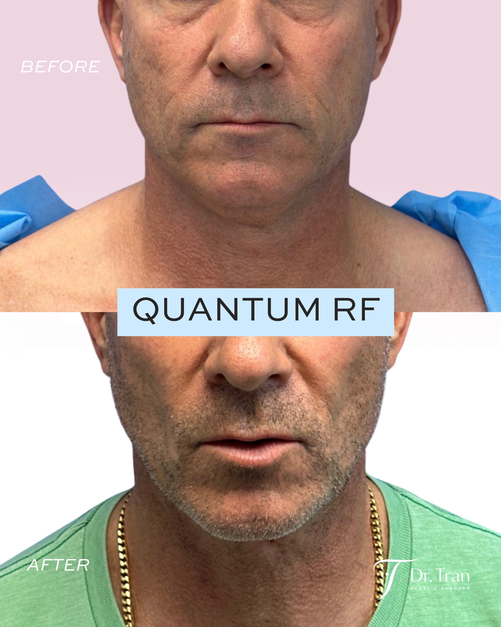 Before and After Image: Neck and Jawline Skin tightening with Quantum RF after liposuction - front