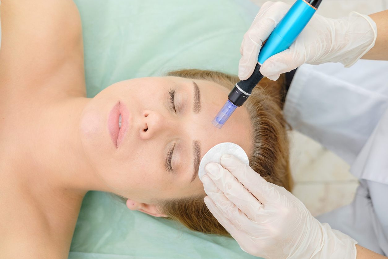 Close-up of a patient getting microneedling treatment on her face for fresh, renewed skin.
