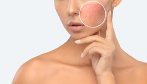 Close-up of a woman with redness and rough texture on her face, in need of Ultraclear laser skin resurfacing.