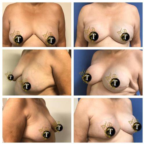 Breast-Augmentation-1