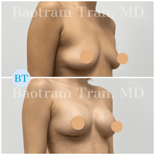 Breast-Augmentation-3