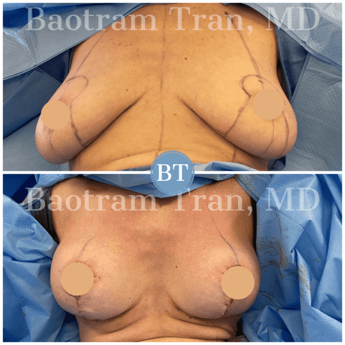 breast lift without implants