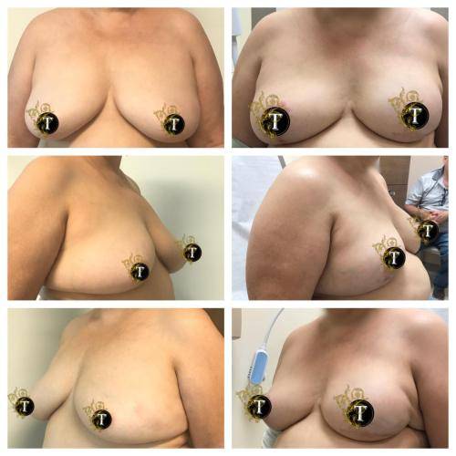 Breast-reconstruction-1