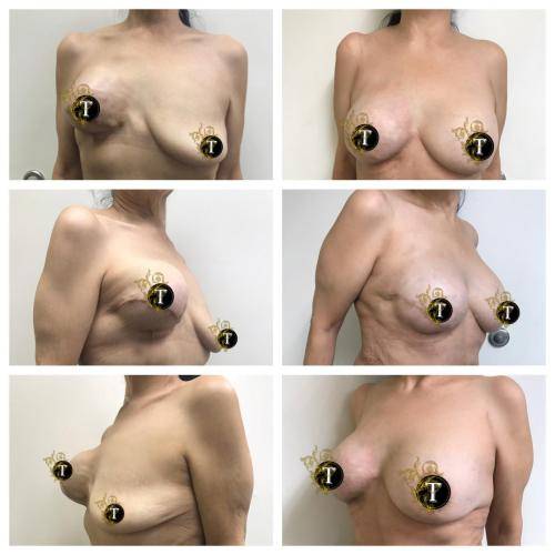 Breast-reconstruction
