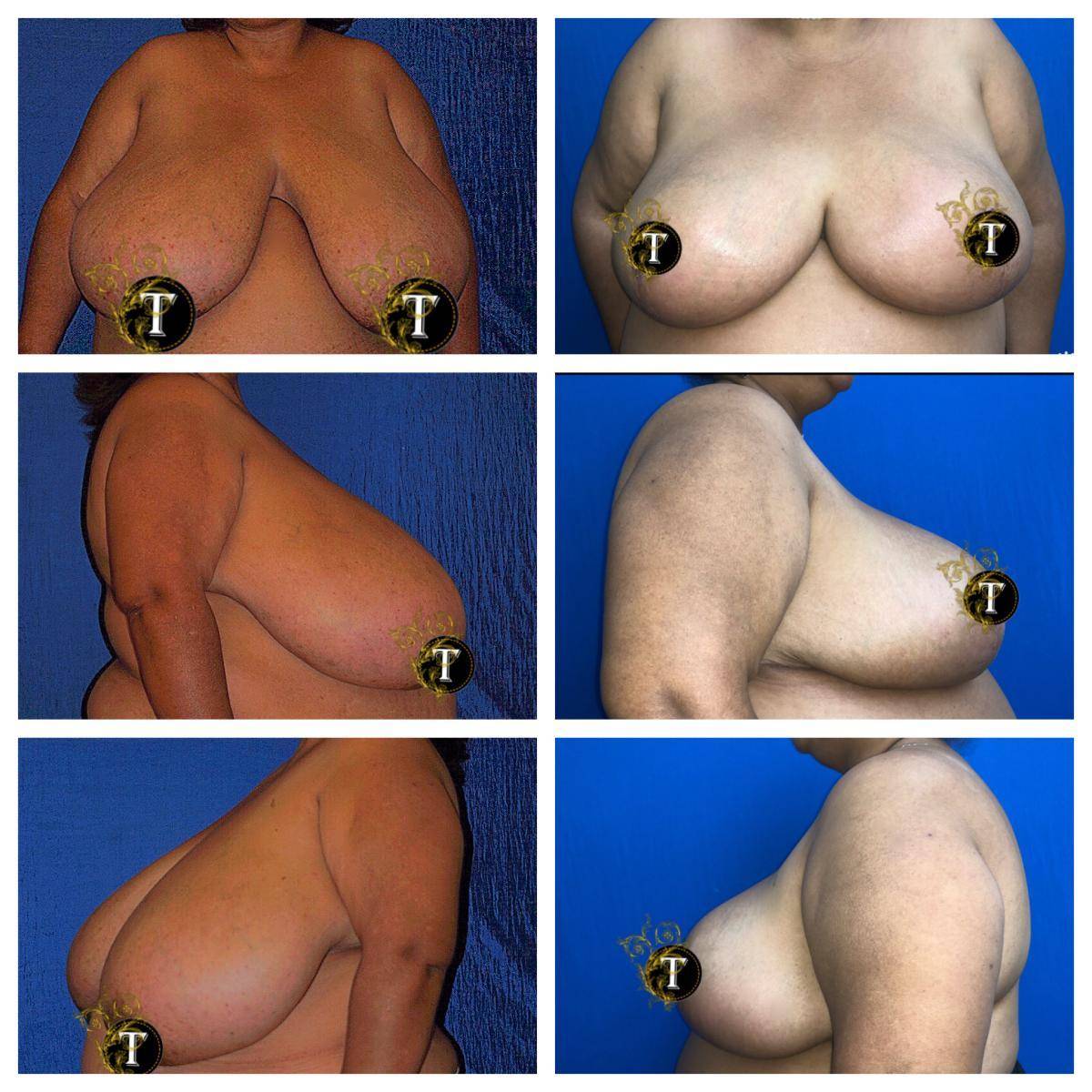 Breast-Reduction