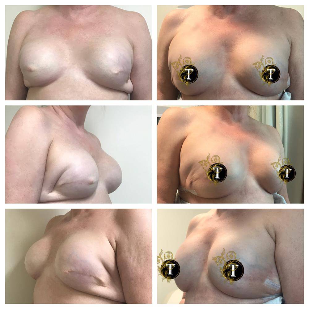 Breast-Revision-1