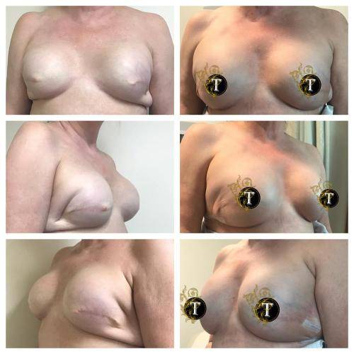Breast-Revision-1