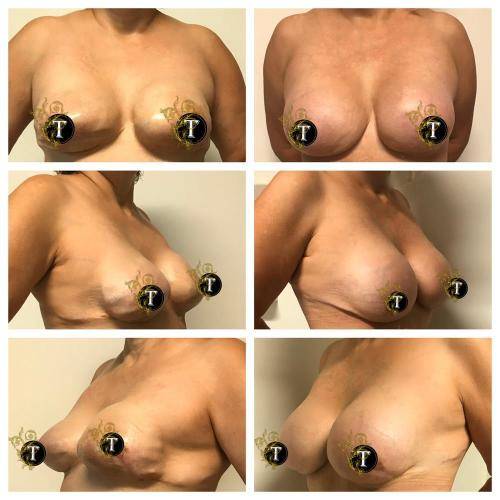Breast-Revision