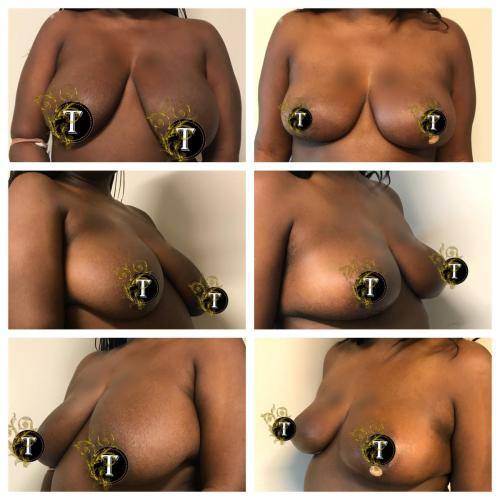 Oncoplastic-breast-reduction-4