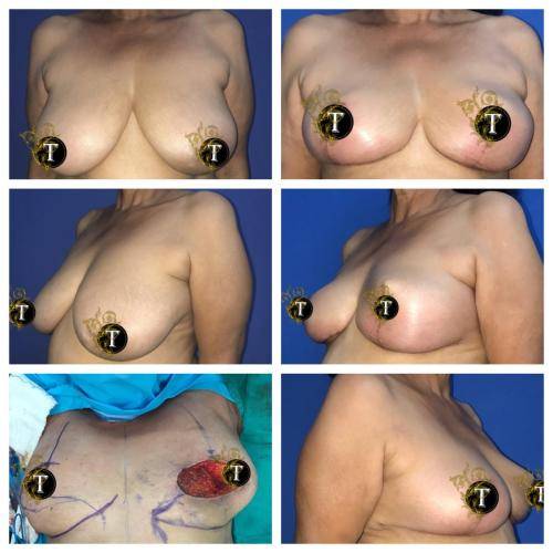 Oncoplastic-breast-reduction-5